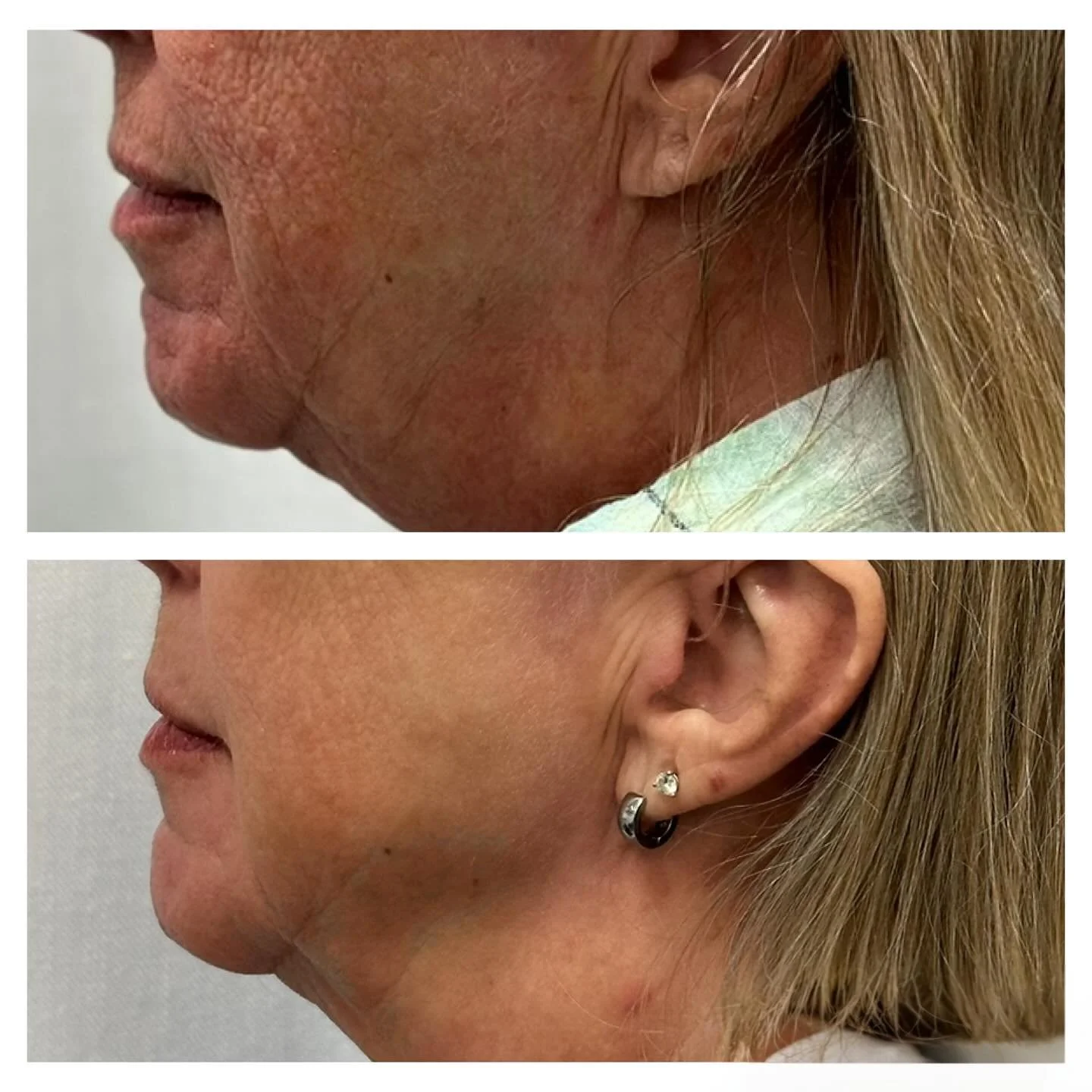 Check out this dramatic transformation after just 3 microneedling sessions with PDO AfterGlo ✨
A visibly lifted jawline, smoother texture, more even skin tone, and noticeably reduced fine lines &mdash; all from stimulating your skin&rsquo;s own colla