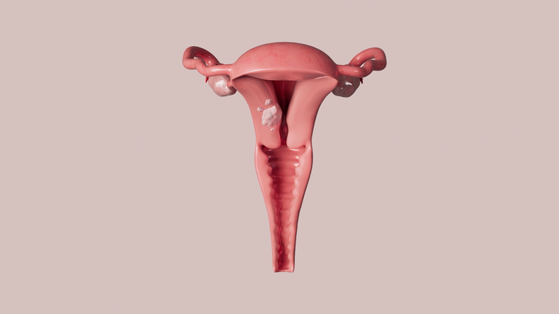 Women’s Sexual Health After Pelvic Radiation Animation