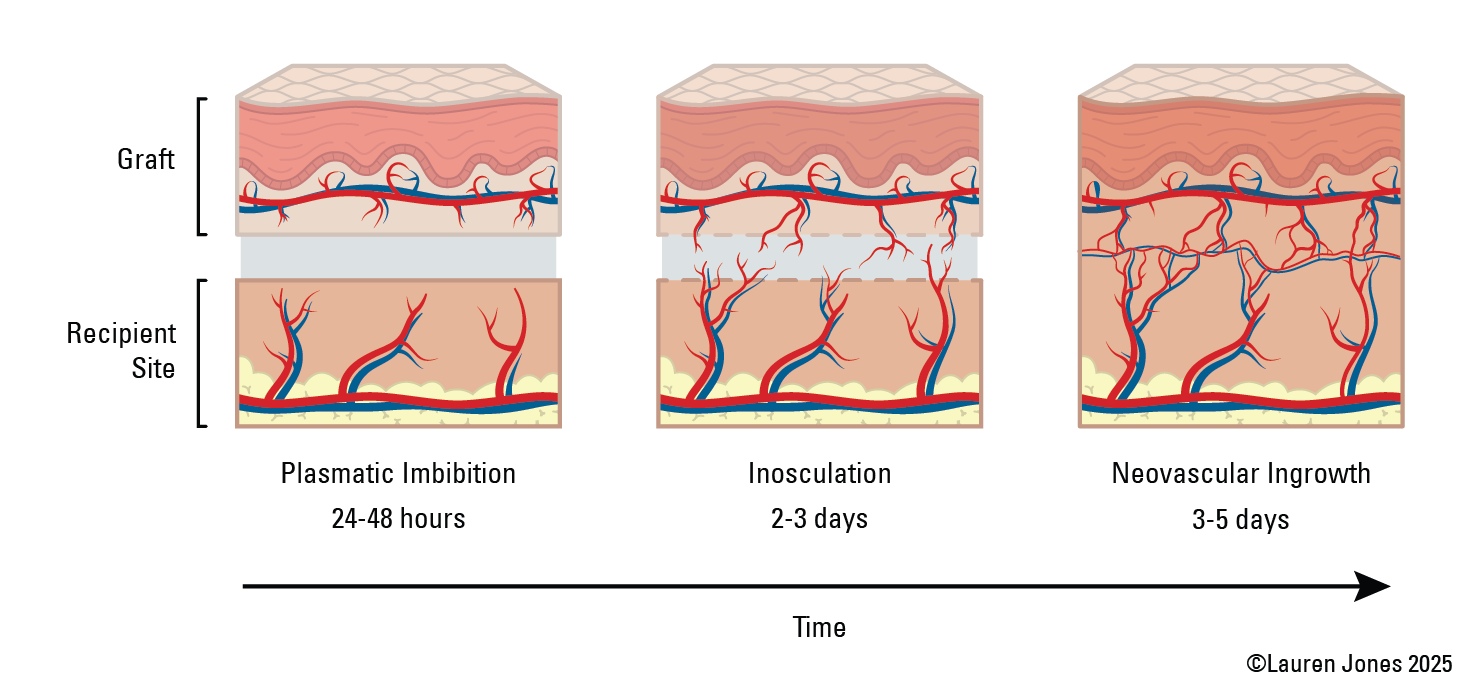 PlasticSurgery_New_Figure#18_PhasesofSkinGraftTake_Colour.png