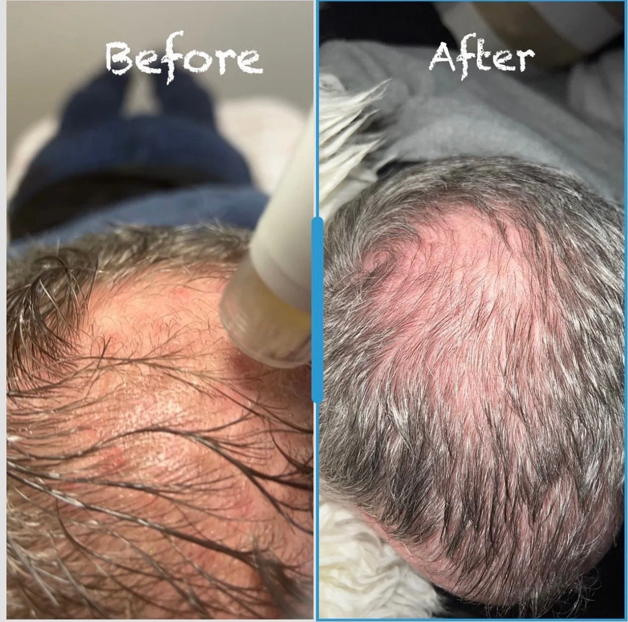 Meso Hair Booster 1 Treatment 30 days later.jpg