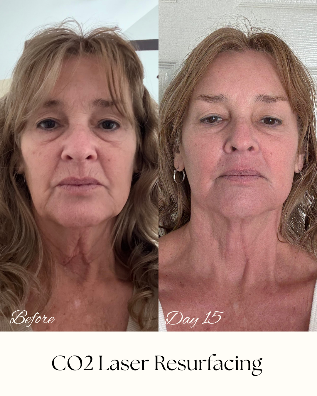 CO2 Laser Resurfacing.png