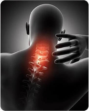 Neck Pain From Brazilian Jiu-Jitsu (BJJ)