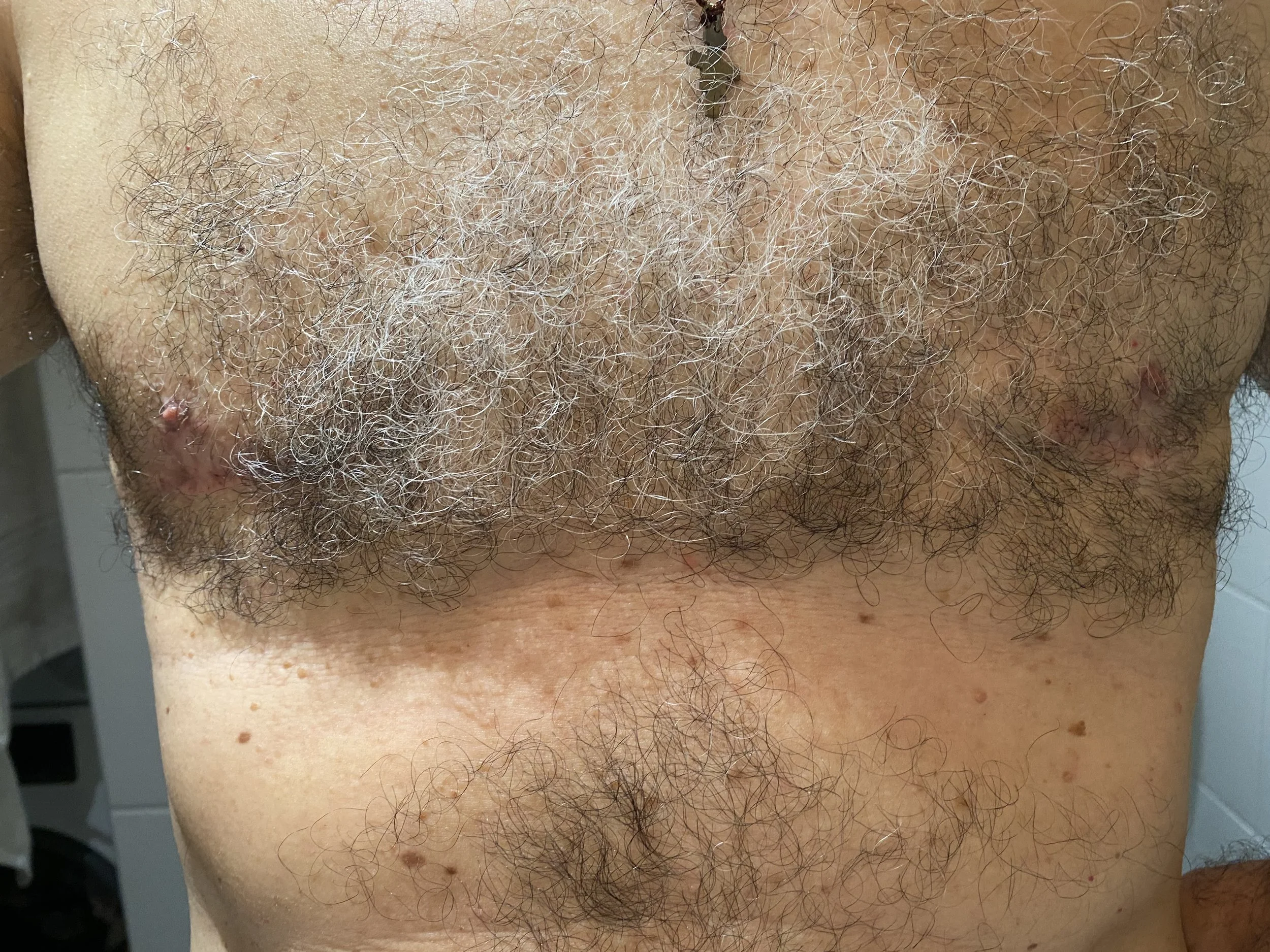 Areolatatuointi   Ennen