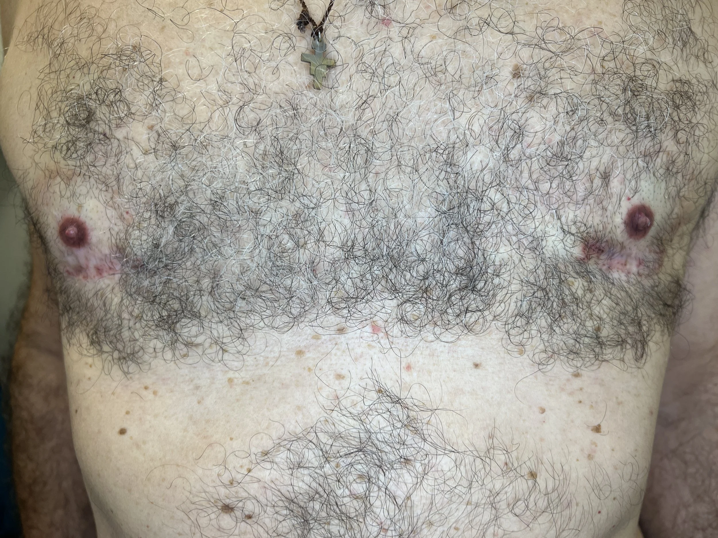 Areolatatuointi   Jälkeen