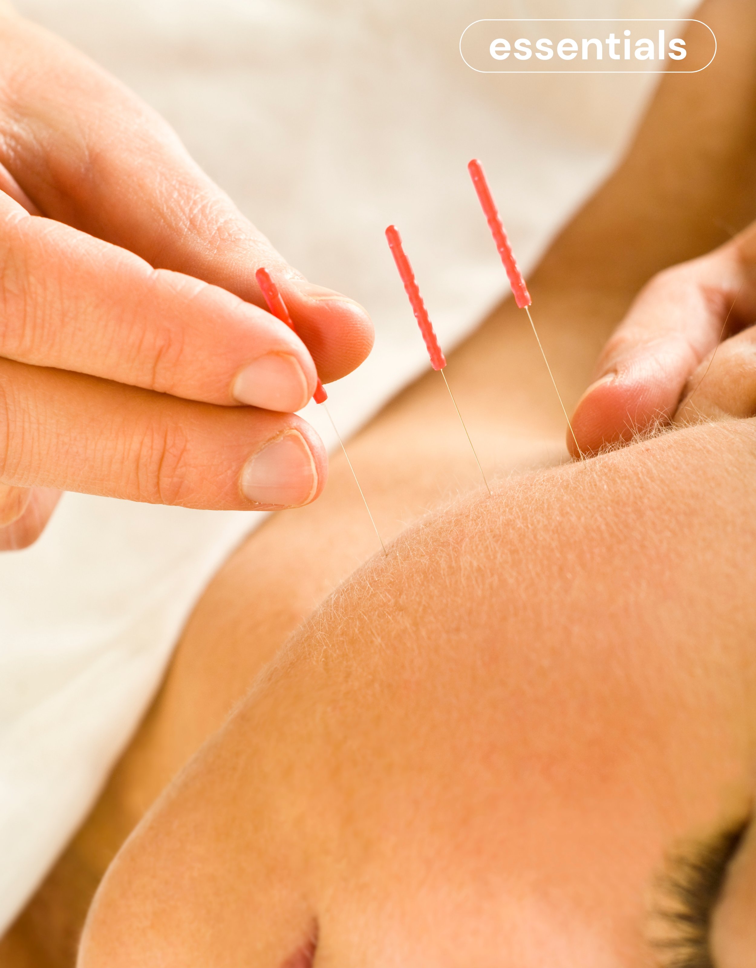Cosmetic Acupuncture