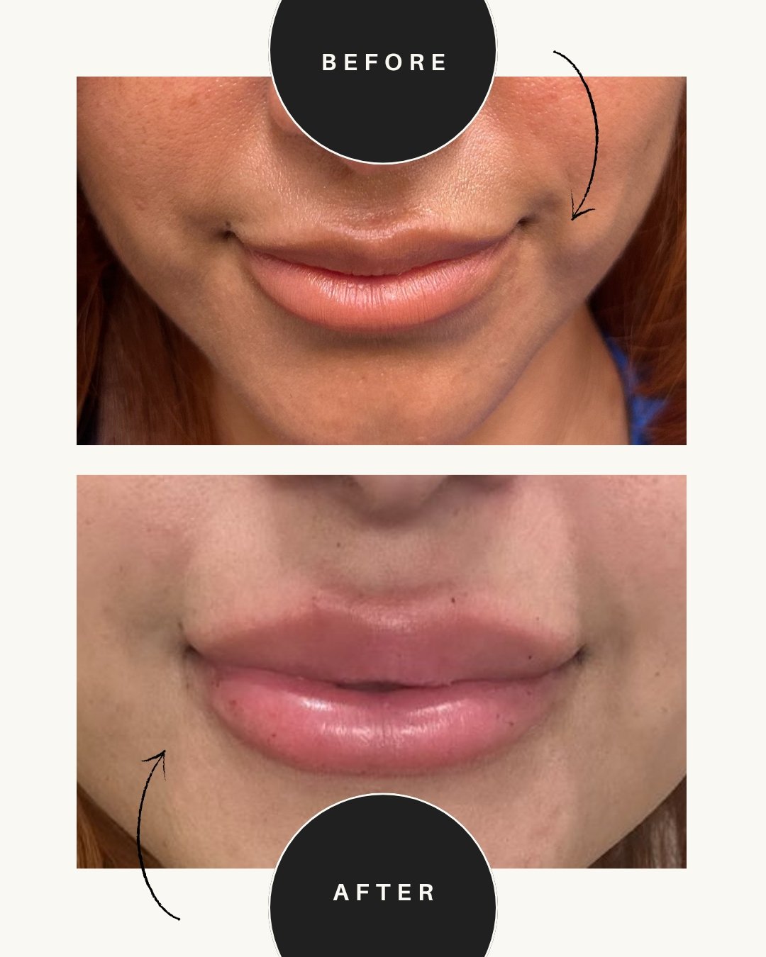 Because your lips deserve to be as bold (or as natural) as you want! 💋✨ #RefinedRadiance #LipTransformation