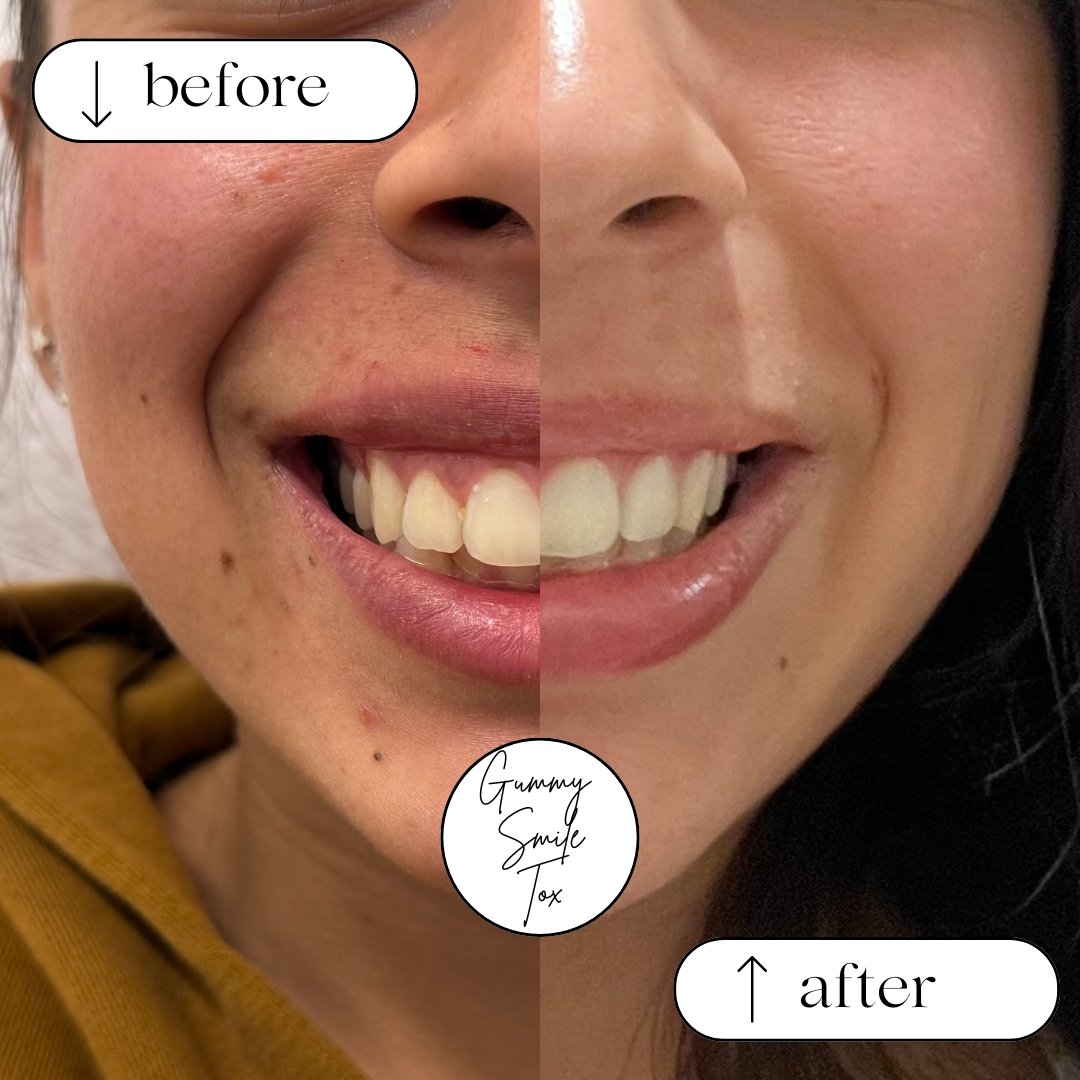 Subtle adjustments, stunning results. 😍 This treatment created a more harmonious smile while preserving natural expression.
Ready for your transformation? DM us! #ConfidentSmile #RefinedRadiance #GummySmileFix