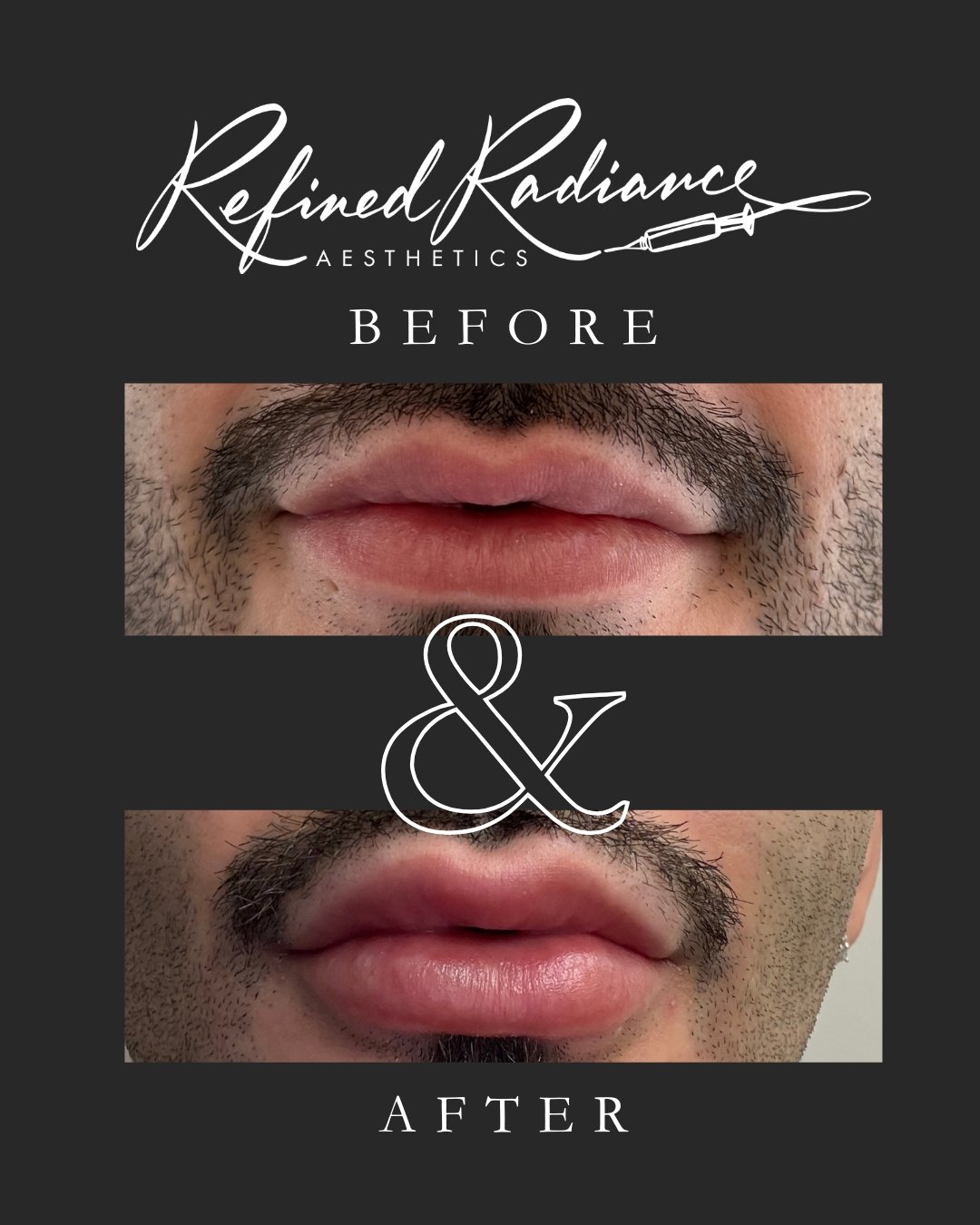 ✨ From Uneven to Unstoppable! ✨
See this stunning transformation! We dissolved previous filler done by another provider (goodbye, lumps + bumps 👋) and carefully restored natural-looking volume. The result? A smooth, balanced pout that moves beautif