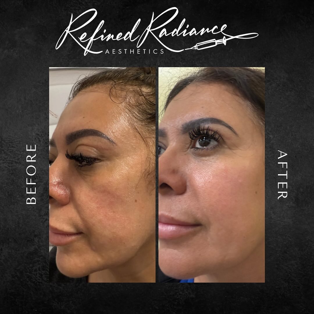 ✨ Just 1 Session, Stunning Results! ✨
Look at the transformation after just ONE Endymed RF Microneedling treatment! 🔥 Notice the improved skin texture, faded discoloration, and that gorgeous jawline tightening? This is only the beginning!
For op