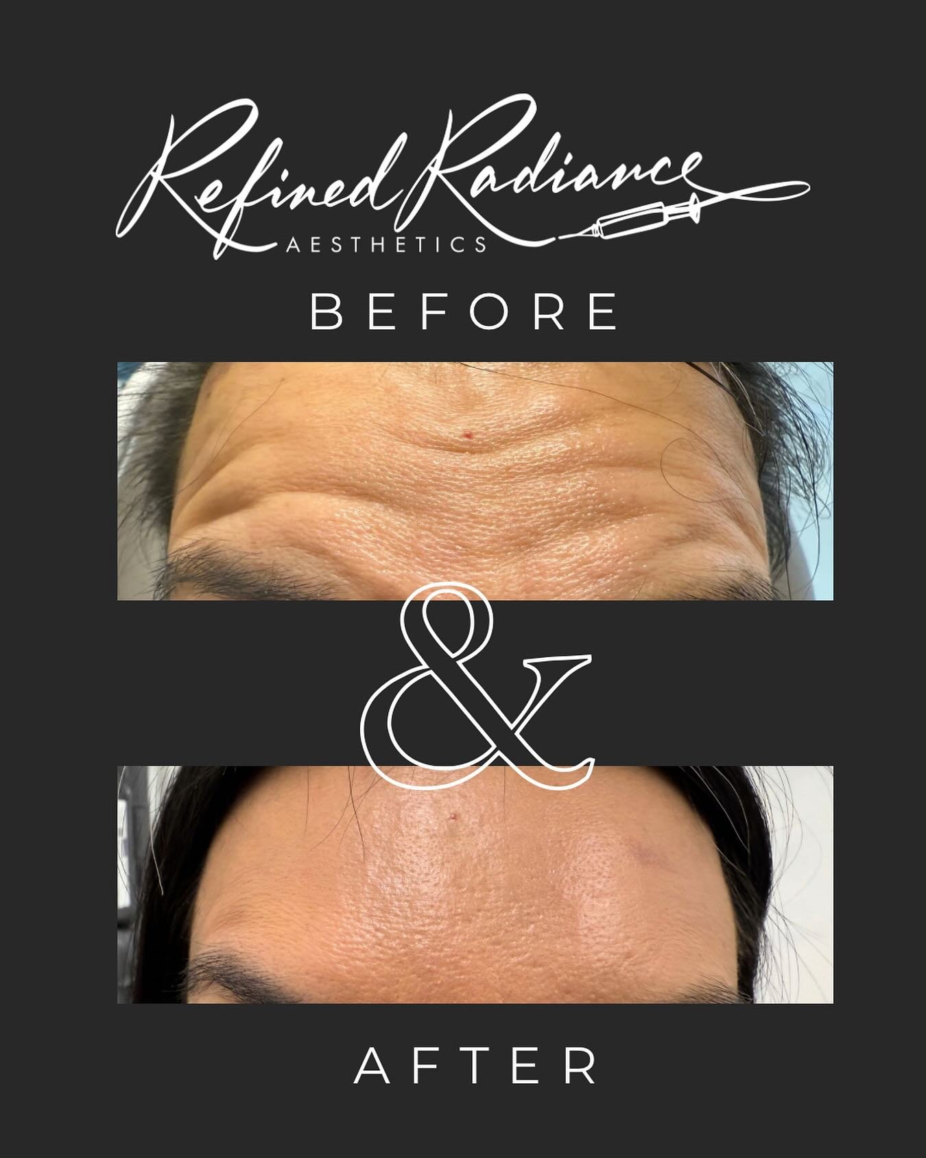 Forehead lines? Erased. Confidence? Elevated. ✨
Our expert Tox treatments at Refined Radiance Aesthetics deliver smooth, natural-looking results, so you can glow without the guesswork.
💉 Softer, refreshed, & perfectly you
📅 Book your appoint