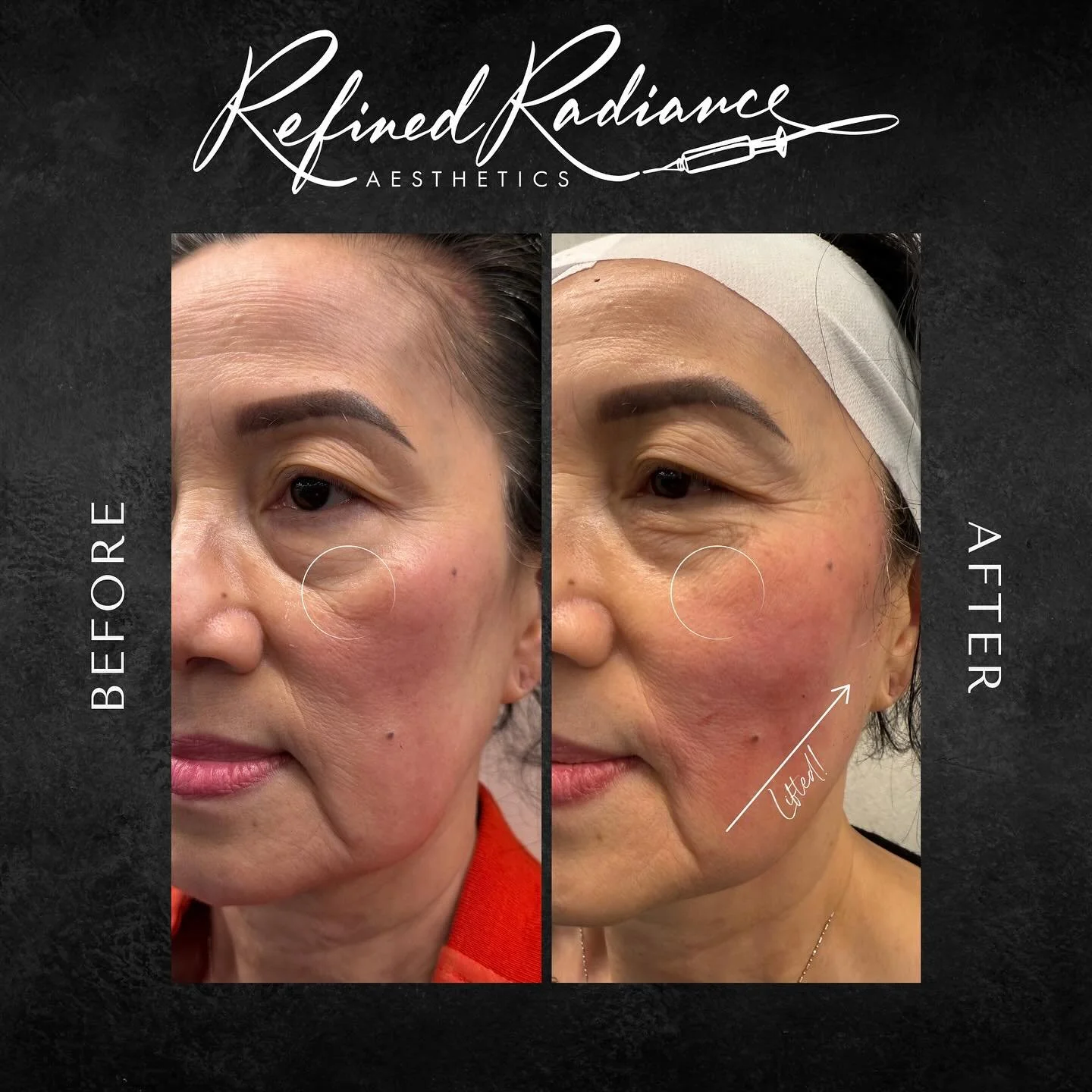 ✨ Turn Back Time with PDO Threads! ✨
See the stunning lift, sculpt, and natural rejuvenation our PDO thread lift delivers! No surgery, no downtime, just refined radiance with expert precision. 🌟
💉 Lift • Tighten • Refresh
📅 Minimal dow