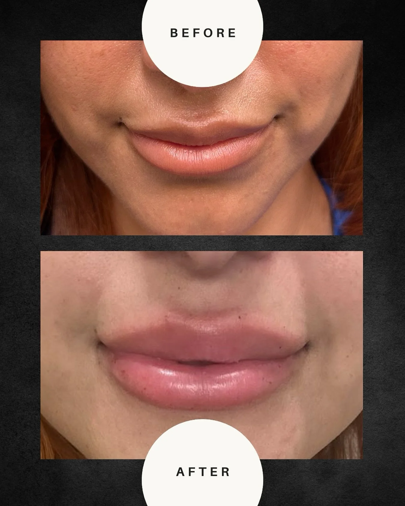 ✨ Just a little refinement for natural, lush lips! ✨
Swipe to see the stunning transformation! Our expert injectors enhance your natural beauty with precision and artistry, because subtlety is everything. 💋
Ready for your own #RefinedRadiance? DM