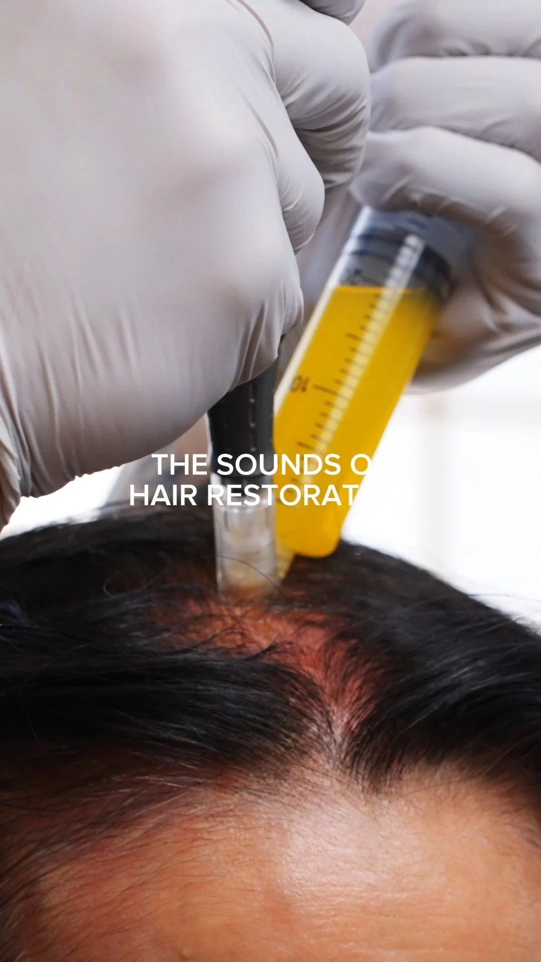 Turn the volume up… π§ This is the sound of healing. Our PRP hair restoration treatment is a simple, effective procedure that can help rejuvenate your scalp and promote natural hair growth. Ready to experience the transformation? π‍βοΈβ¨
#