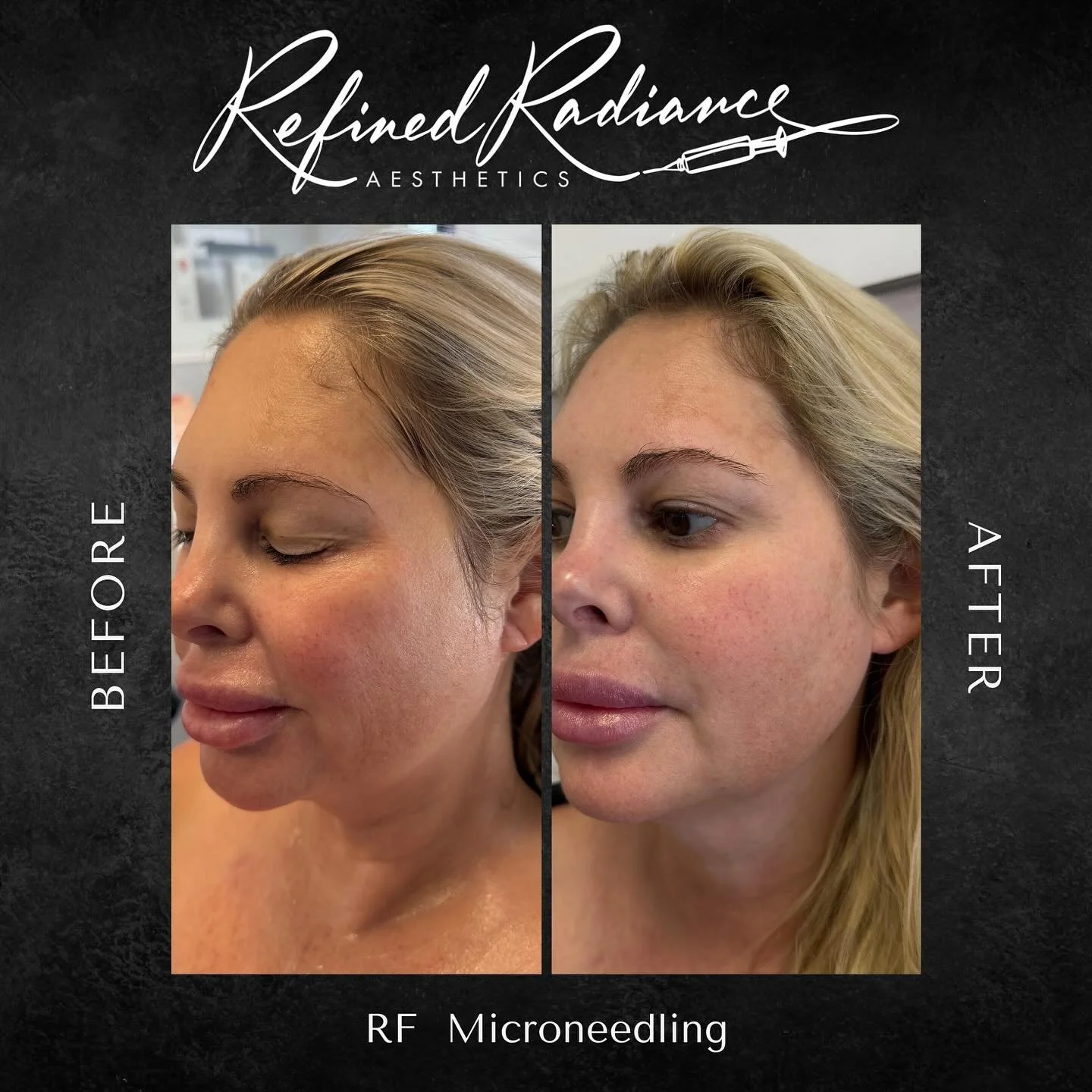 Single Session, Stunning Results! ✨

Swipe to see the incredible transformation from just ONE session of RF Microneedling! This powerful treatment combines the collagen-inducing power of microneedles with the skin-tightening energy of radiofrequency.