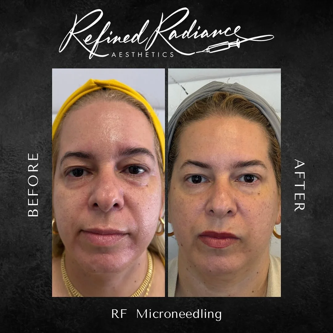 This is the Refined Radiance standard. ✨
We specialize in delivering real, noticeable results. This client’s journey with our RF Microneedling showcases the dramatic yet natural improvement in skin quality and radiance we achieve for our patie