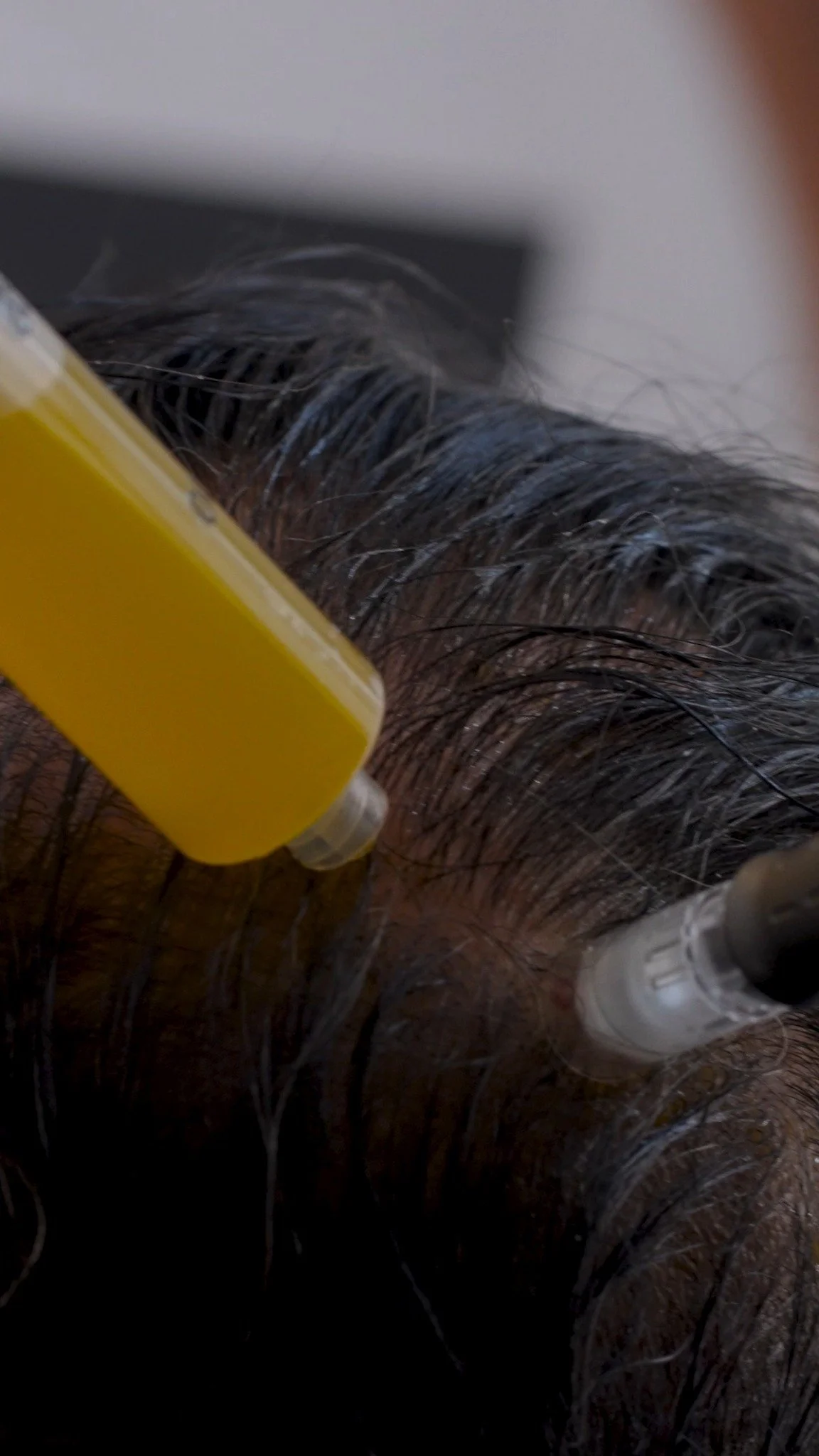 We’re here to help you on your hair restoration journey. ✨
PRP Hair Restoration uses your own platelets to stimulate growth, strengthen follicles, and improve scalp health, all naturally. 💉💪
It’s safe, effective, and designed to bring