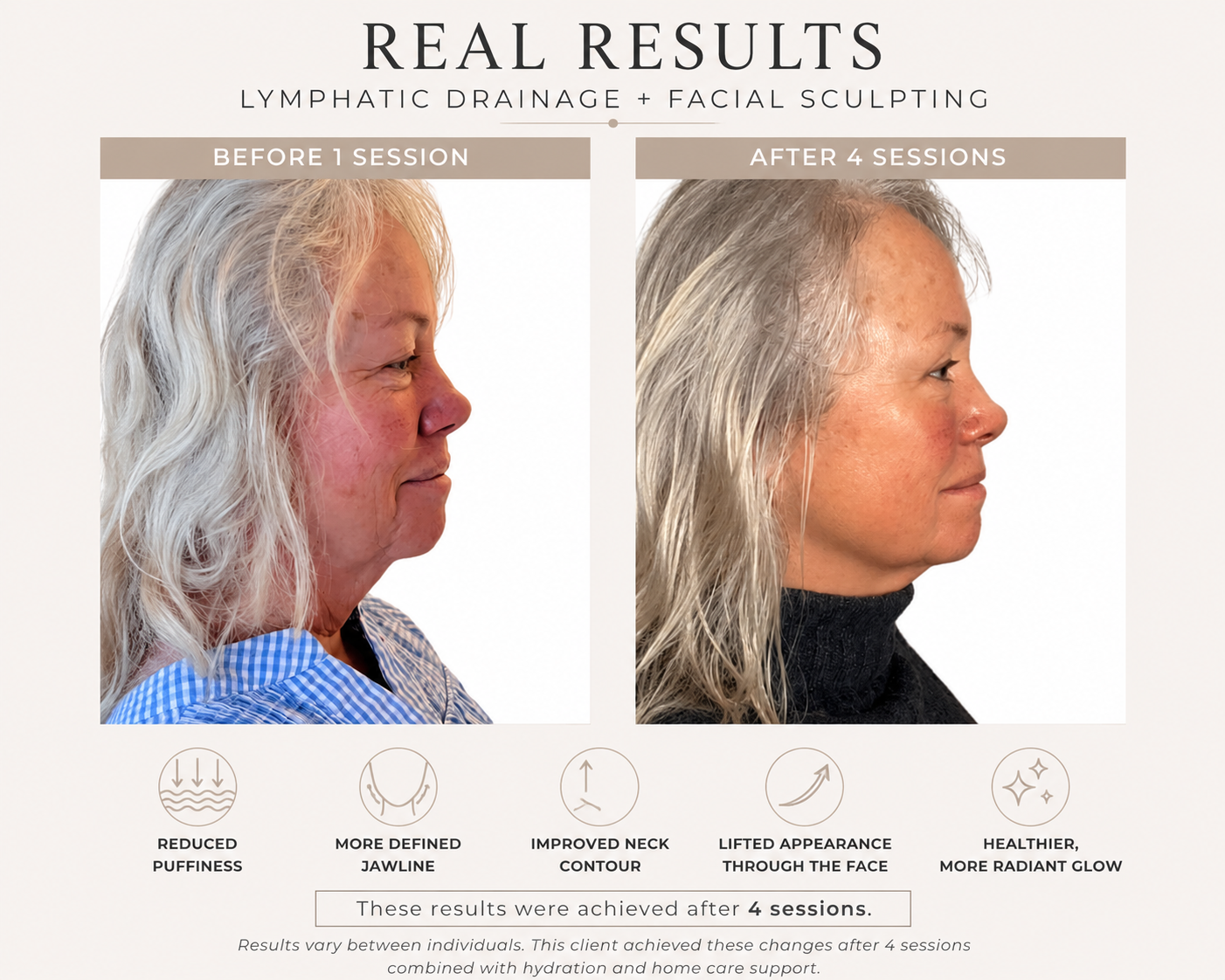 Side-by-side comparison of a woman's face before and after 4 lymphatic drainage and facial sculpting sessions, showing improved jawline, neck contour, and radiant glow.