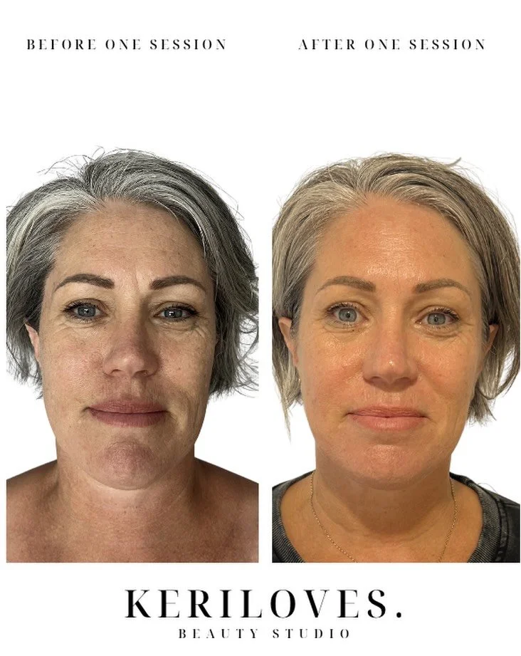 This beautiful woman 🤍 
Trusted the process, softened into it, and let her body do what it&rsquo;s designed to do.

This is before and after ONE session.
Less puffiness
More definition
More flow

But what I see most&hellip;
is a settled nervous syst