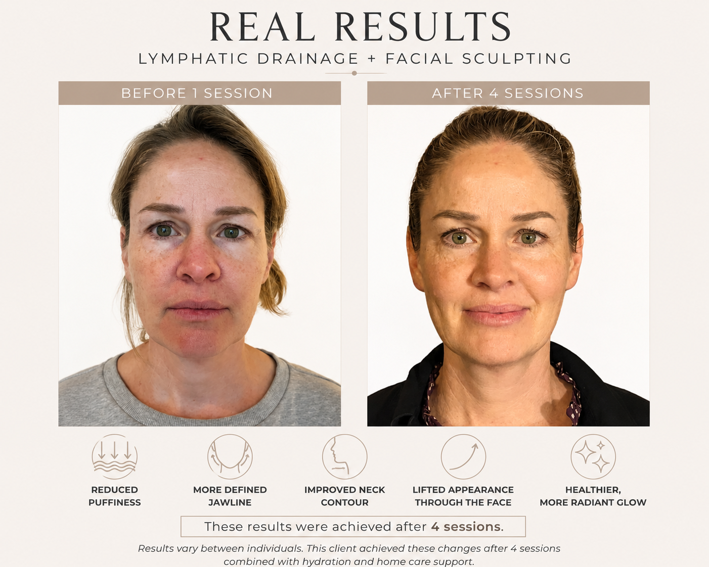Before and after photos of a woman showing results of lymphatic drainage and facial sculpting, with improvements in puffiness, jawline definition, neck contour, and skin glow after four sessions.