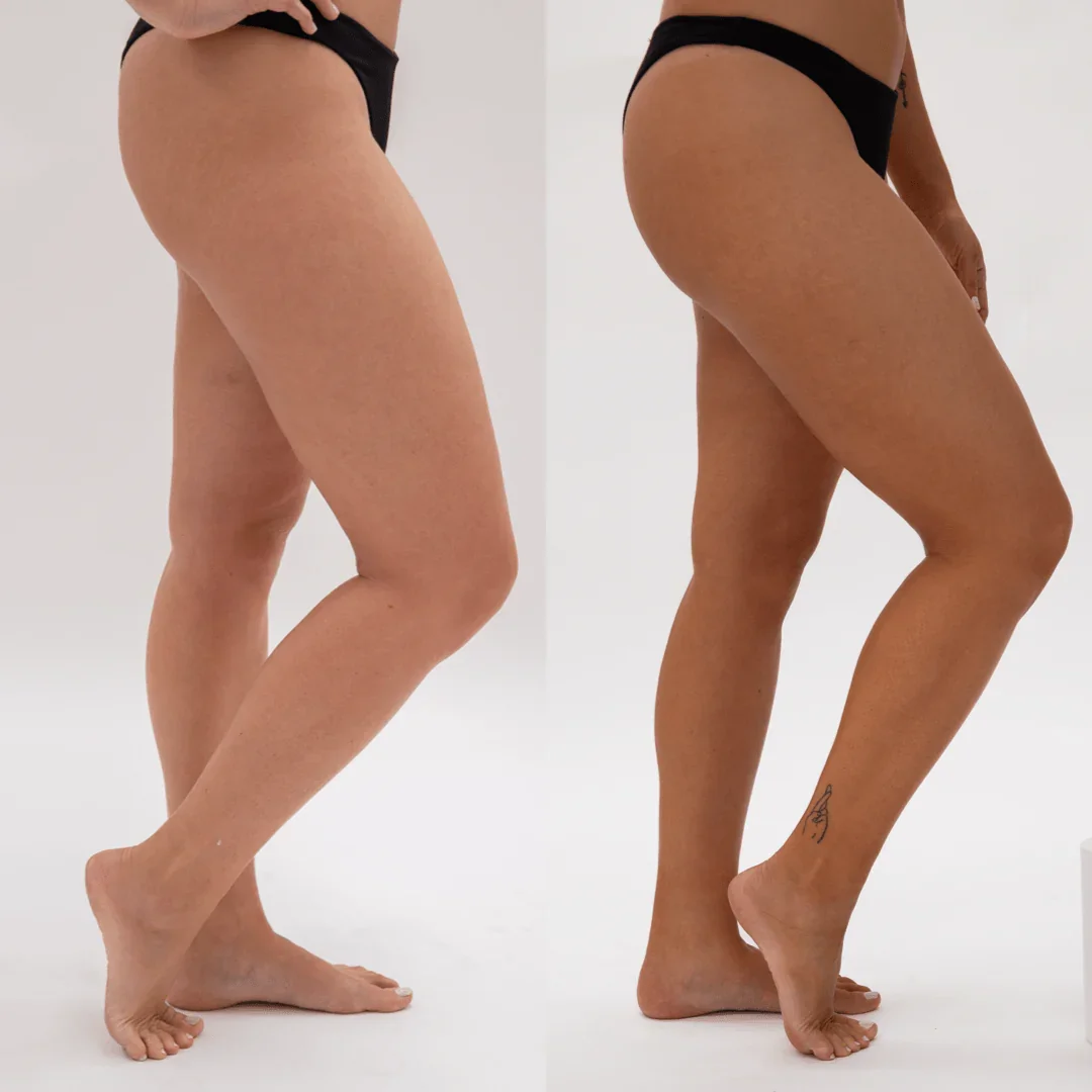 Side-by-side comparison of a woman's legs before and after a skincare treatment, with slight differences in skin texture and tone, wearing black underwear against a plain white background.