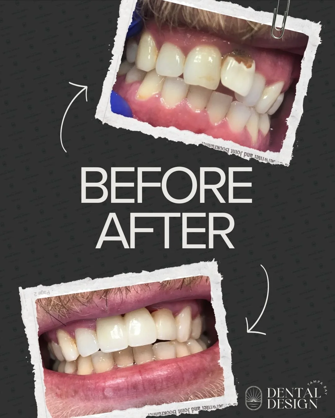 That&rsquo;s the power of a confident smile 😁 Ready for your own transformation? We&rsquo;re here to help!