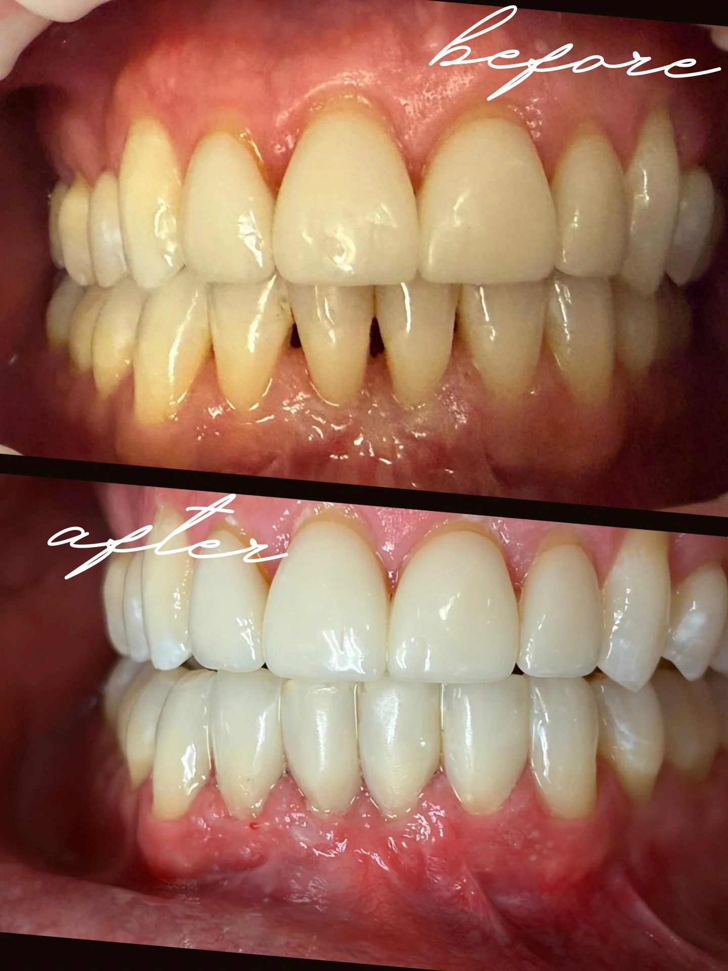 Ever notice some little triangular gaps between your teeth? Don&rsquo;t like the way they look? Did you know that we can complete bonding on them? No tooth structure removal, no drilling. This simple procedure can elevate your smile in a subtle way. 