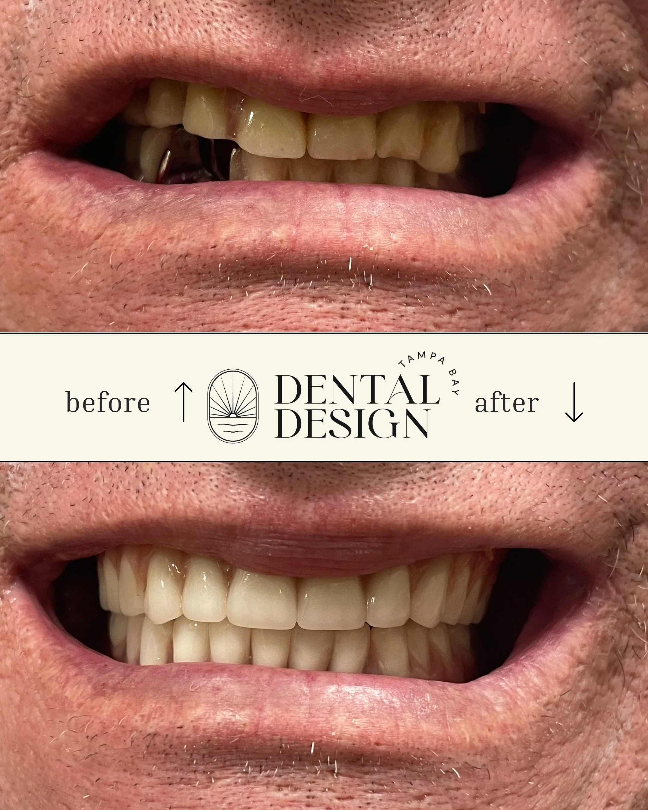 dental patient looking in a mirror; restorative dental care in tampa