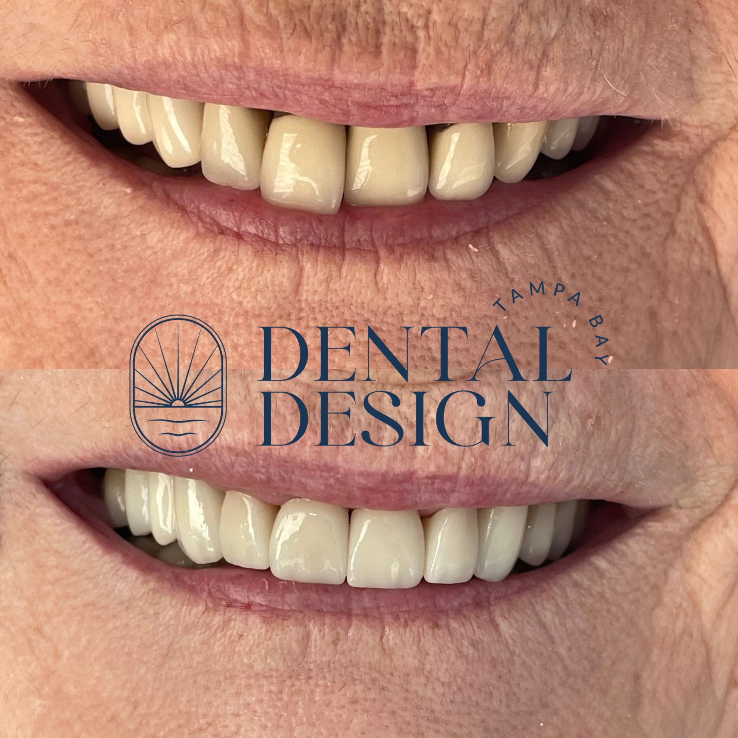 teeth cleaning; restorative dental care in tampa