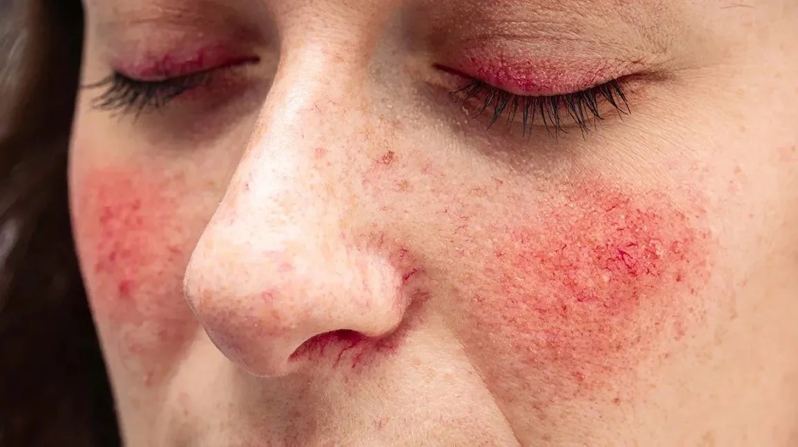 Rosacea Awareness Month: Understanding and Caring for Rosacea