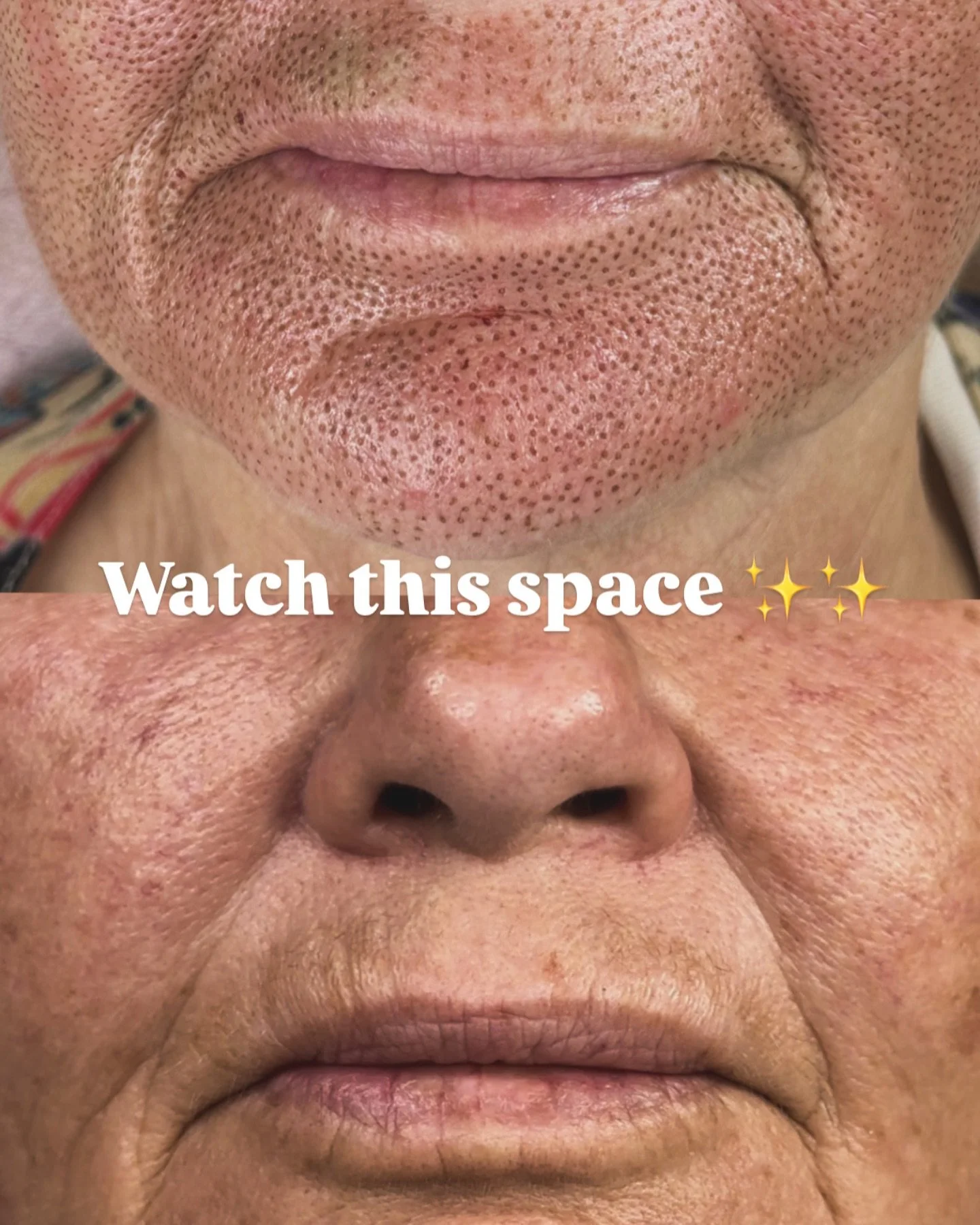 ᴘɪᴄᴛᴜʀᴇᴅ
ᴀʀᴇᴀ: [✨Special✨] LOWERFACE 
ᴘʀɪᴄᴇ: $499.00 for 2 Fibroblast sessions (50% OFF!)
ʜᴇᴀʟɪɴɢ ᴛɪᴍᴇ: 7-14 days 

𝙋𝙡𝙪𝙨 𝙮𝙤𝙪𝙧 𝙨𝙚𝙘𝙤𝙣𝙙 6 𝙬𝙚𝙚𝙠 𝙍𝙀- 𝙩𝙧𝙚𝙖𝙩 𝙘𝙤𝙢𝙥𝙡𝙚𝙩𝙚𝙡𝙮 𝙁𝙍𝙀𝙀!

Book your consultation and take the first s