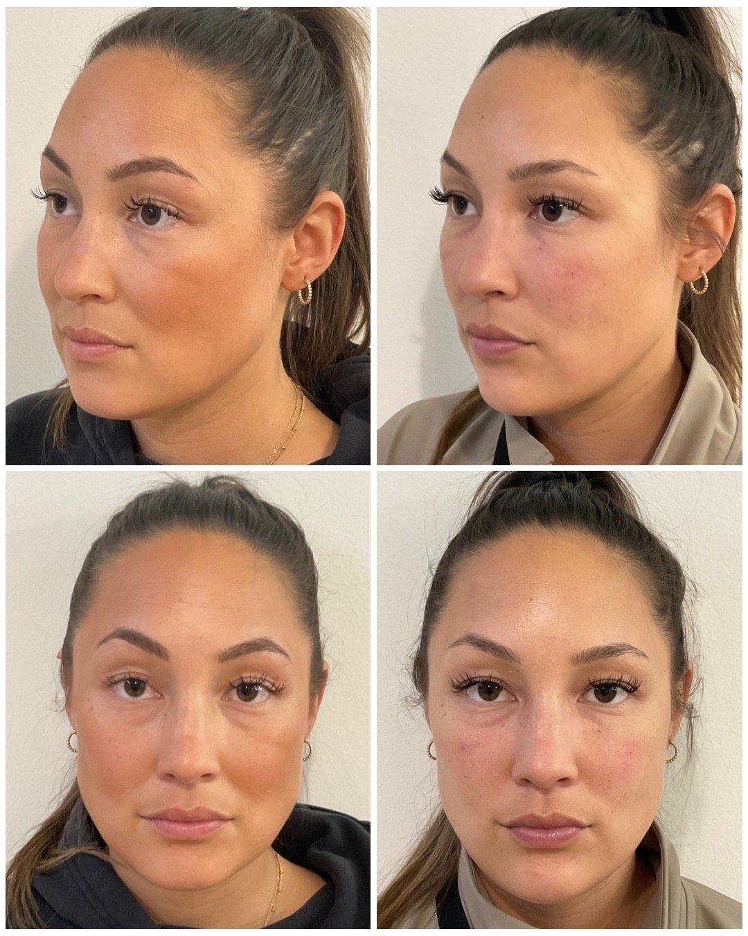 collagen-treatment-portland.jpg