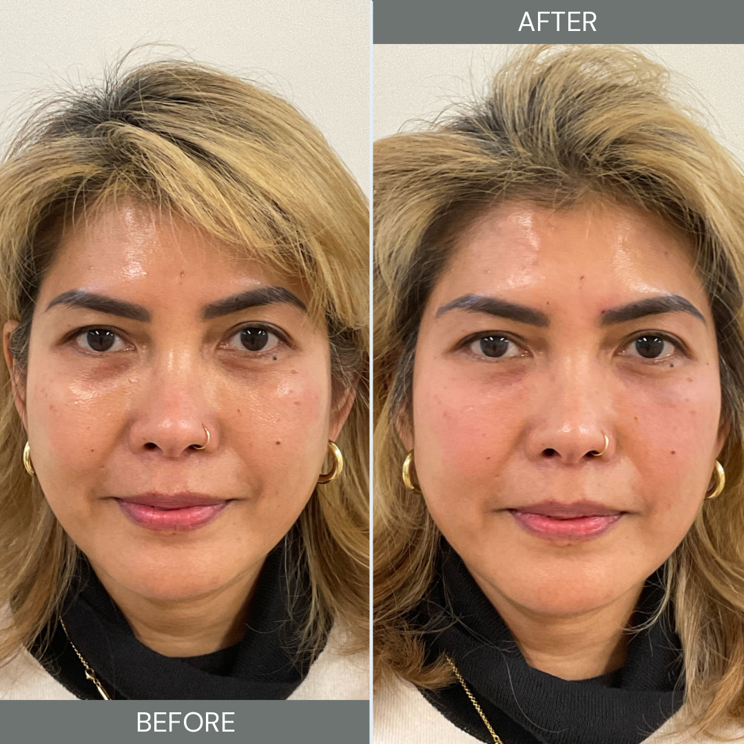 dermal-fillers-portland-medspa.png