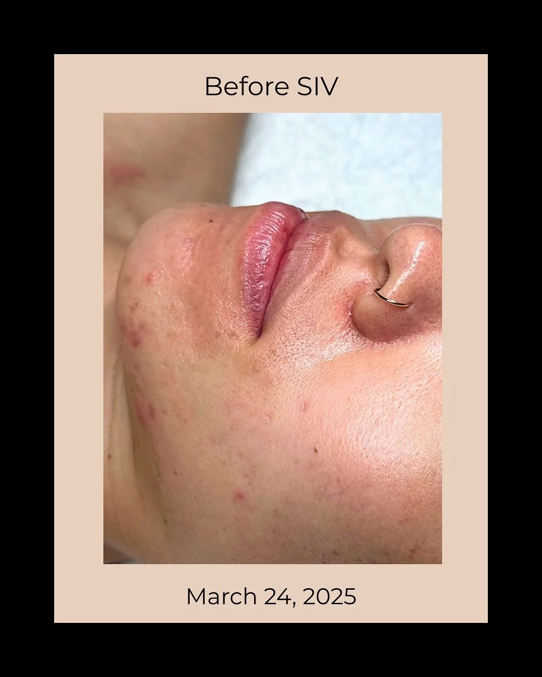 The magic of SIV ✨ 

This guest presented with a damaged barrier, inflamed acne, and suspected perioral dermatitis around her mouth. To the touch, her skin was very dry and textured. 

After using SIV twice per day for 4 months, her skin no longer pr