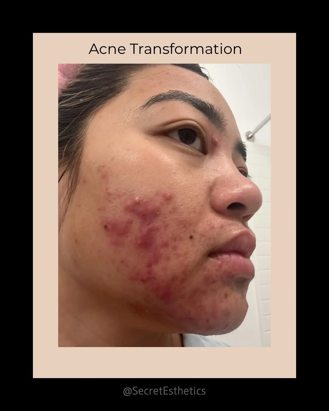 5 month transformation ✨

After discontinuing spironolactone, this guest went into hormone rebound presenting as severe inflamed, cystic nodules. Prior to seeing me, she had attempted cosmetic acupuncture, home remedies and was considering Accutane ?