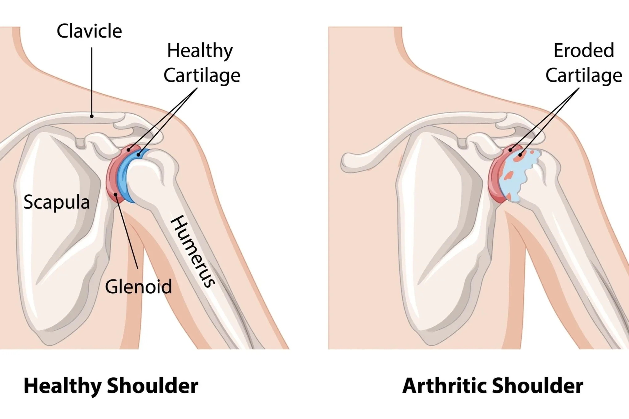 Comparison of healthy and arthritic shoulders showing less erosion in the healthy shoulder and more damaged cartilage in the arthritic shoulder.