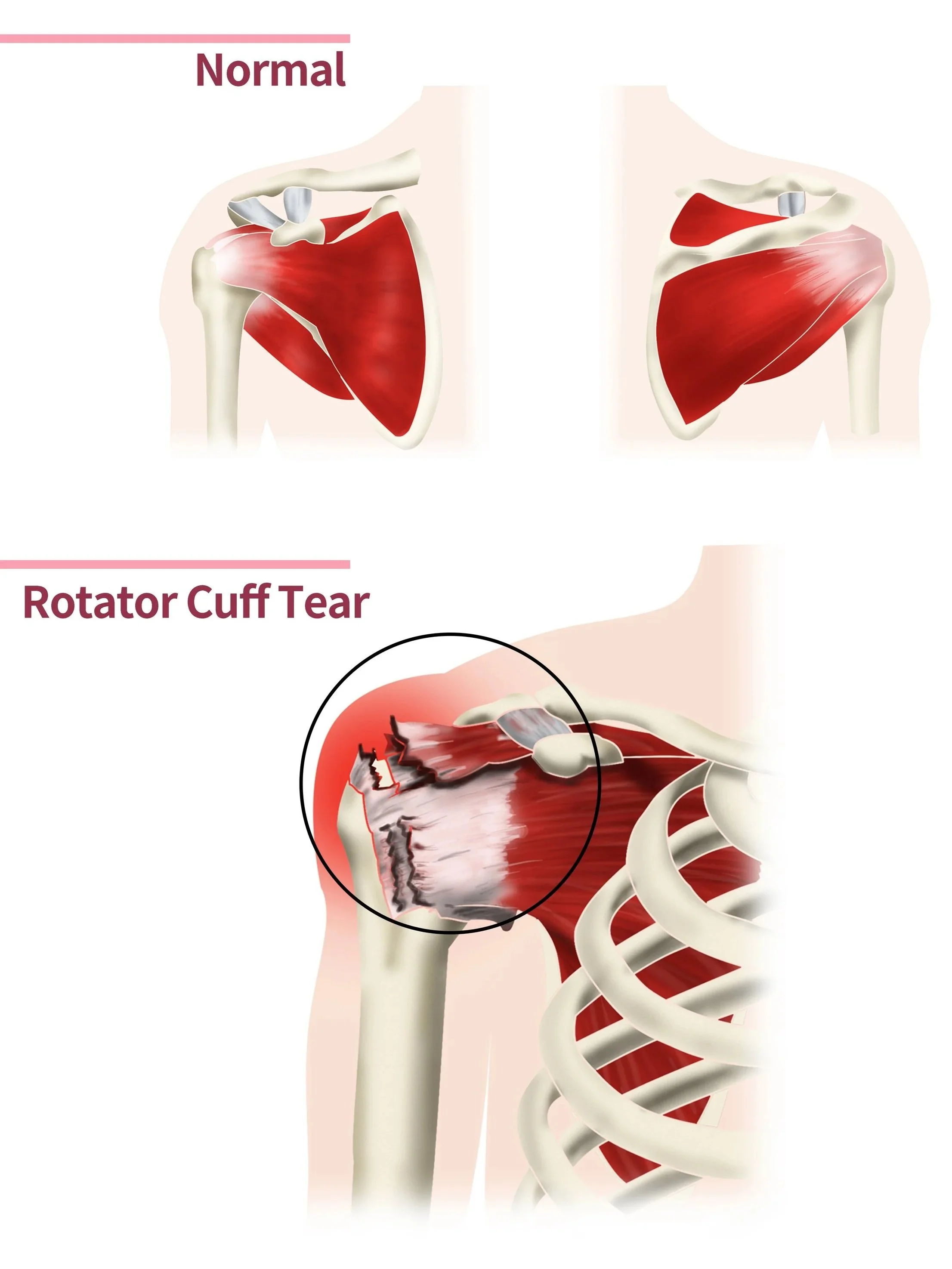 Diagram showing a shoulder with a rotator cuff tear, highlighting damaged muscles and tendons.