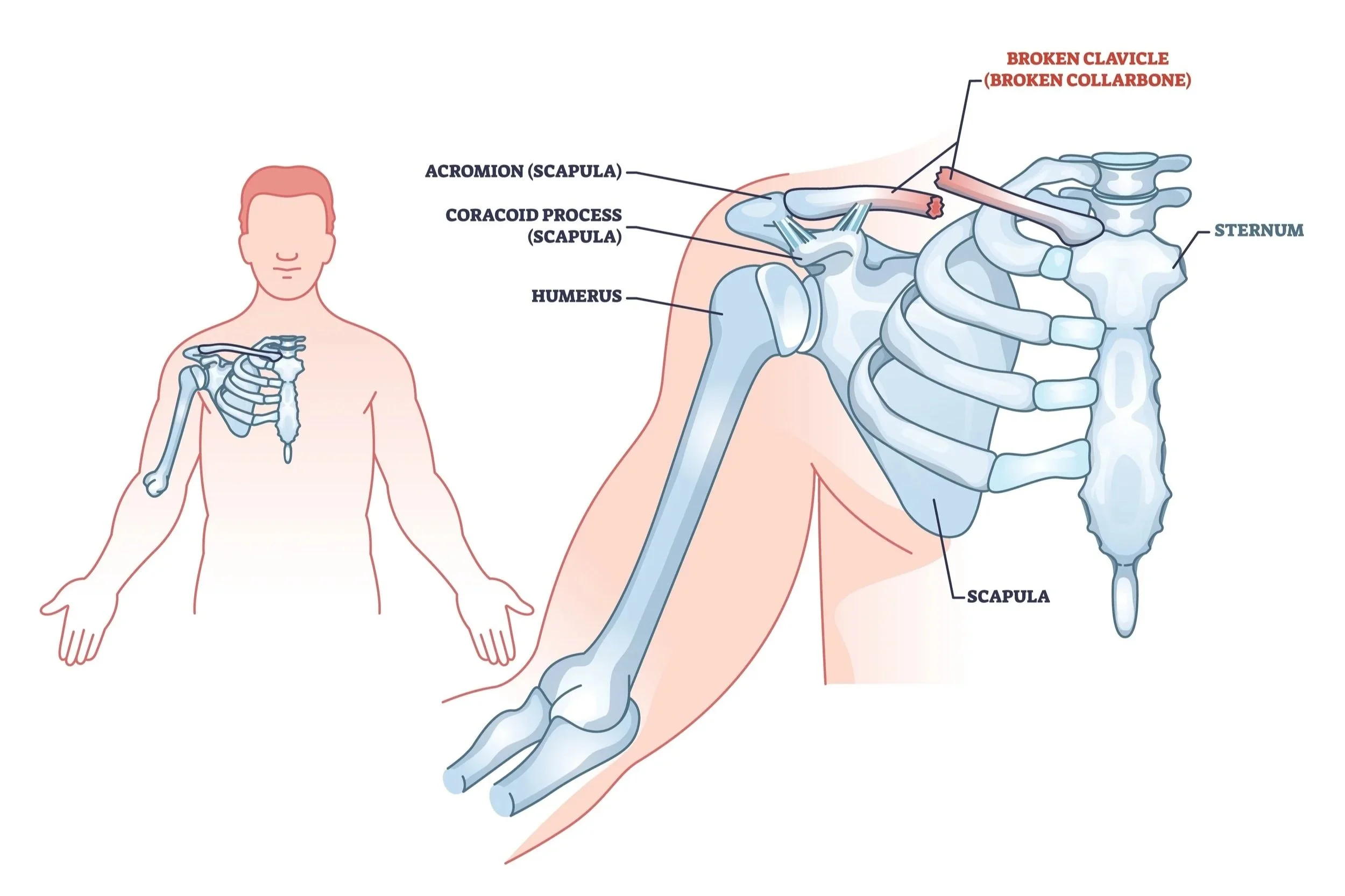 Diagram of a human shoulder with labeled parts including acromion, coracoid process, humerus, scapula, and sternum, highlighting a broken clavicle (collarbone).