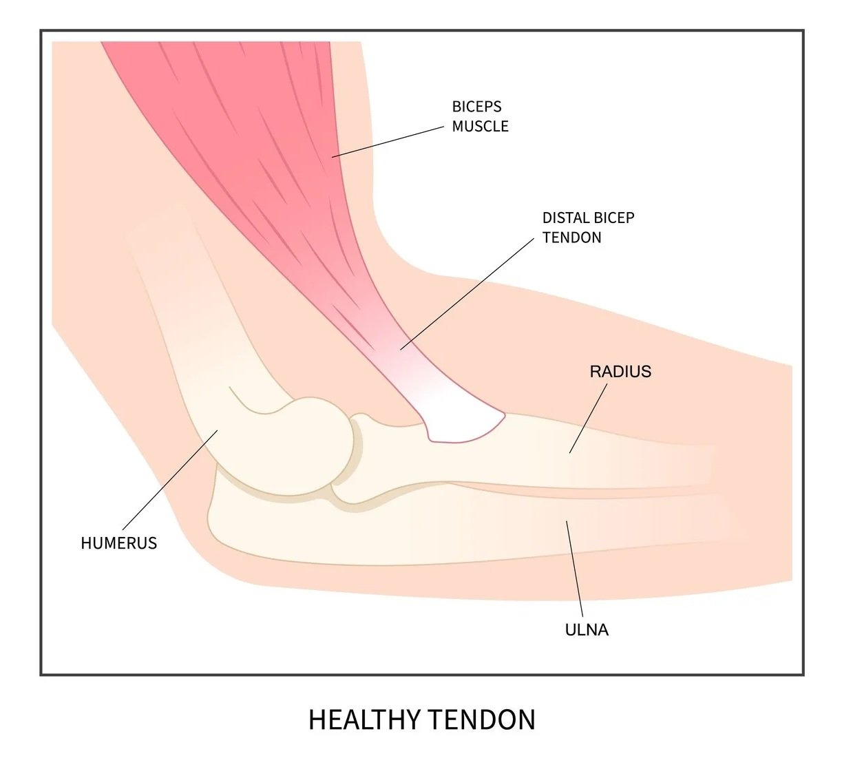 An anatomical illustration of a healthy human elbow highlighting the biceps muscle, distal biceps tendon, radius, ulna, humerus, and showing a healthy tendon.