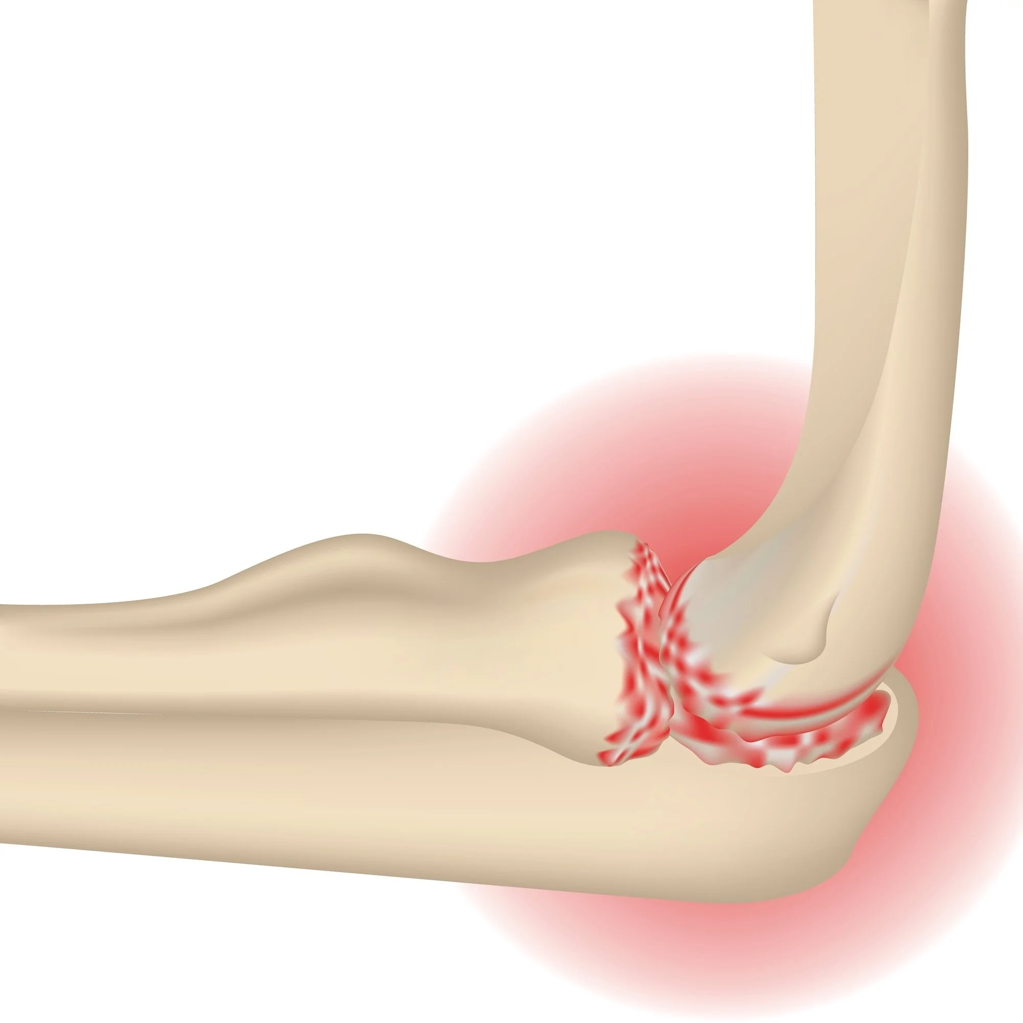 A medical illustration of an elbow with arthritis.