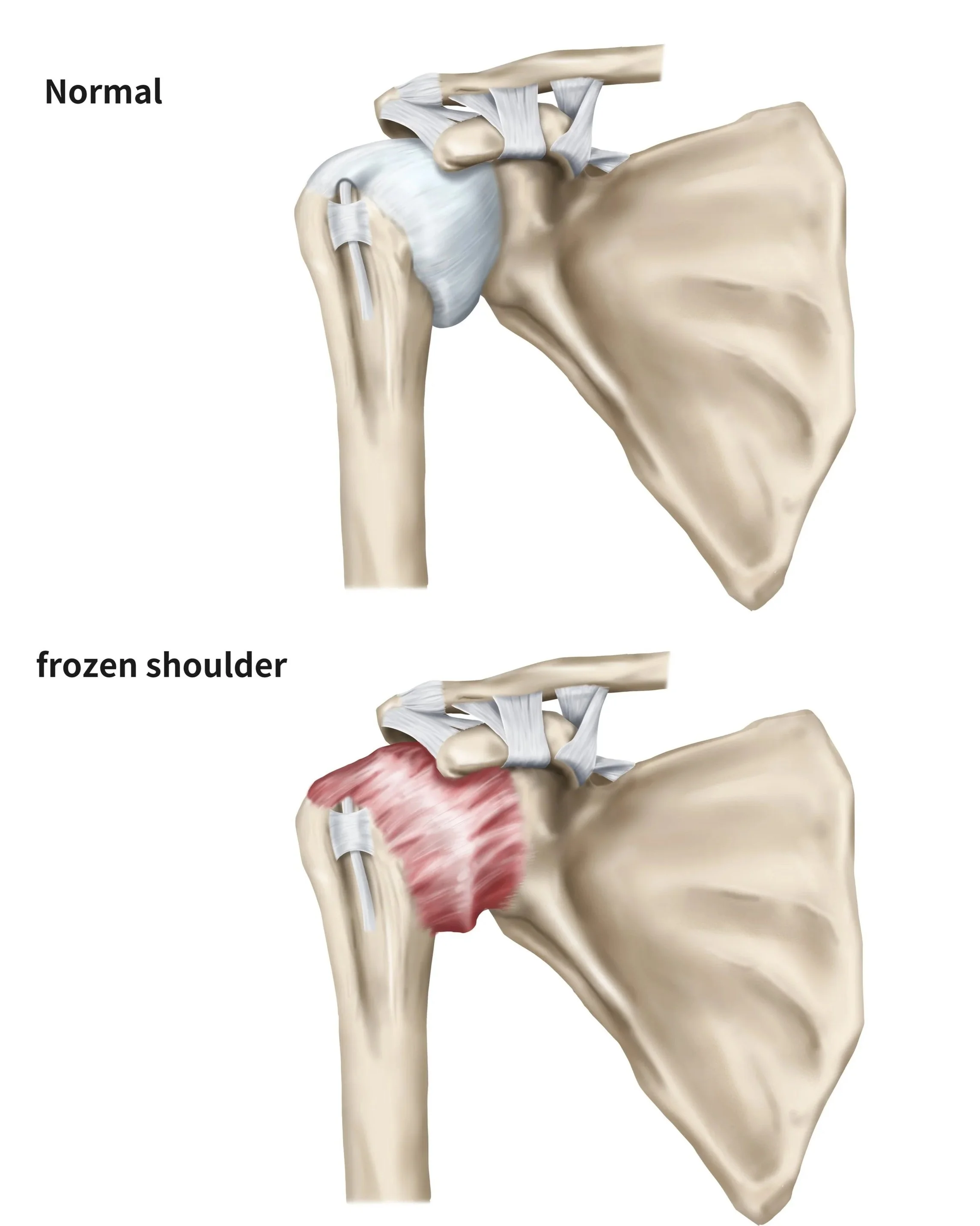 Diagram of a human shoulder joint showing normal anatomy, with the humeral head fitting into the glenoid cavity of the scapula, and surrounding ligaments and muscles.