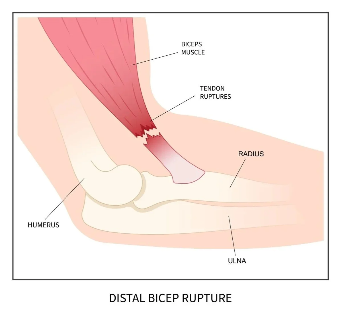 An illustration showing a distal bicep rupture with muscles, tendons, and bones labeled, including the biceps muscle, tendon ruptures, humerus bone, radius, and ulna.