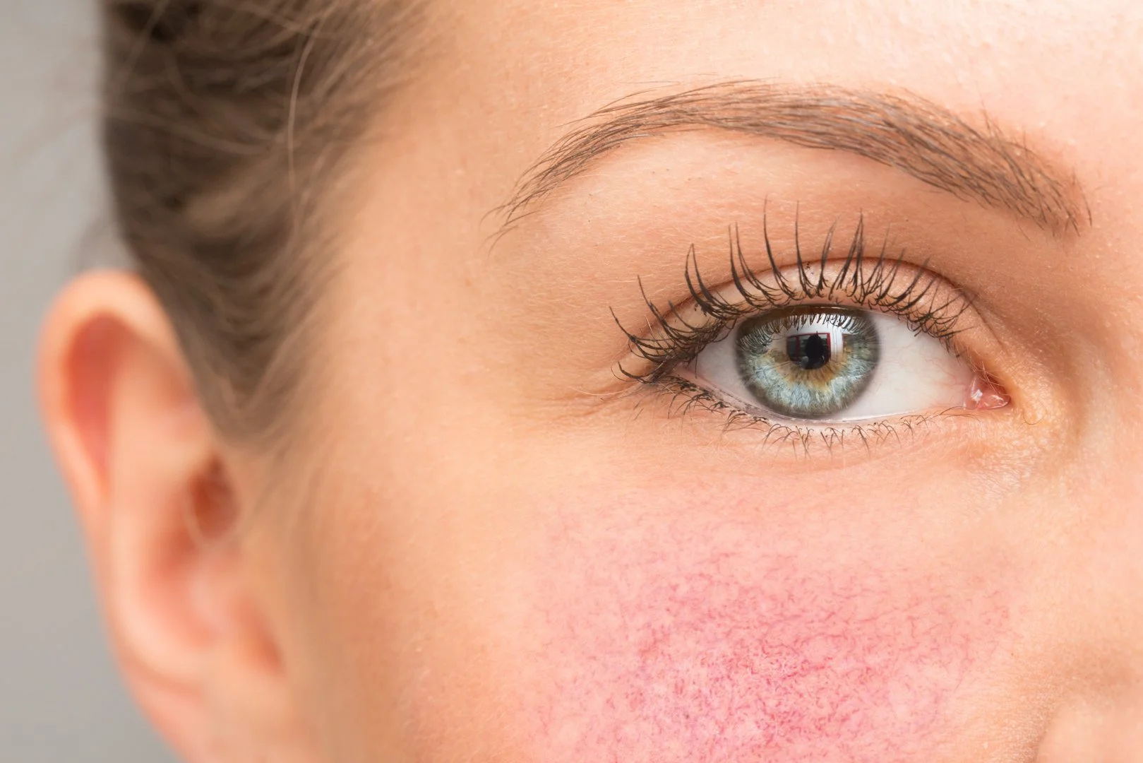 When Skin Is Fragile: The Art of Caring for Rosacea, Eczema &amp; Post-Procedure Sensitivity