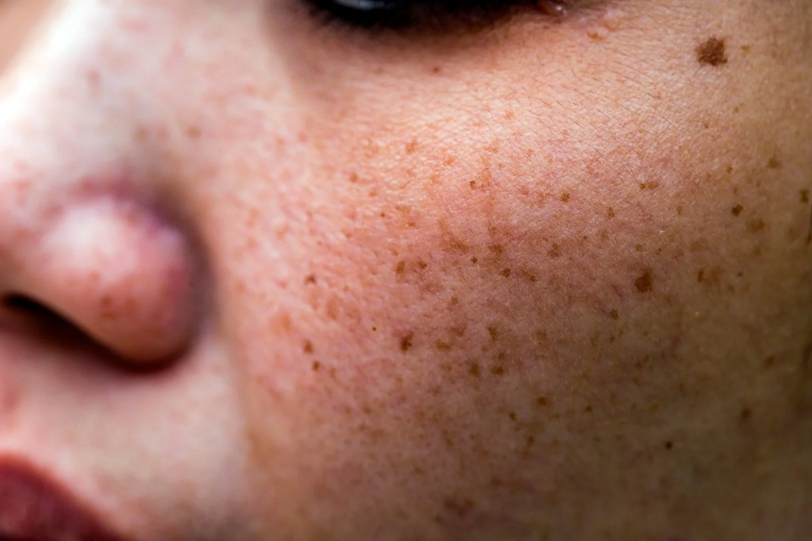 Why Spring Is the Ideal Season for Hyperpigmentation Correction
