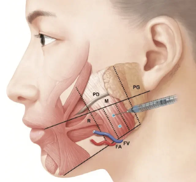 Diagramma anatomico del volto umano che mostra i muscoli, le ghiandole e le strutture della zona mascellare e temporale.