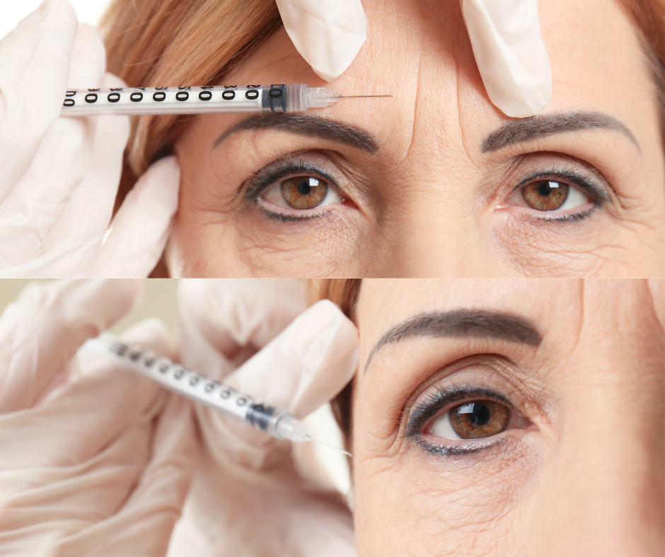 Trattamento con tossina botulinica (botox) a parma