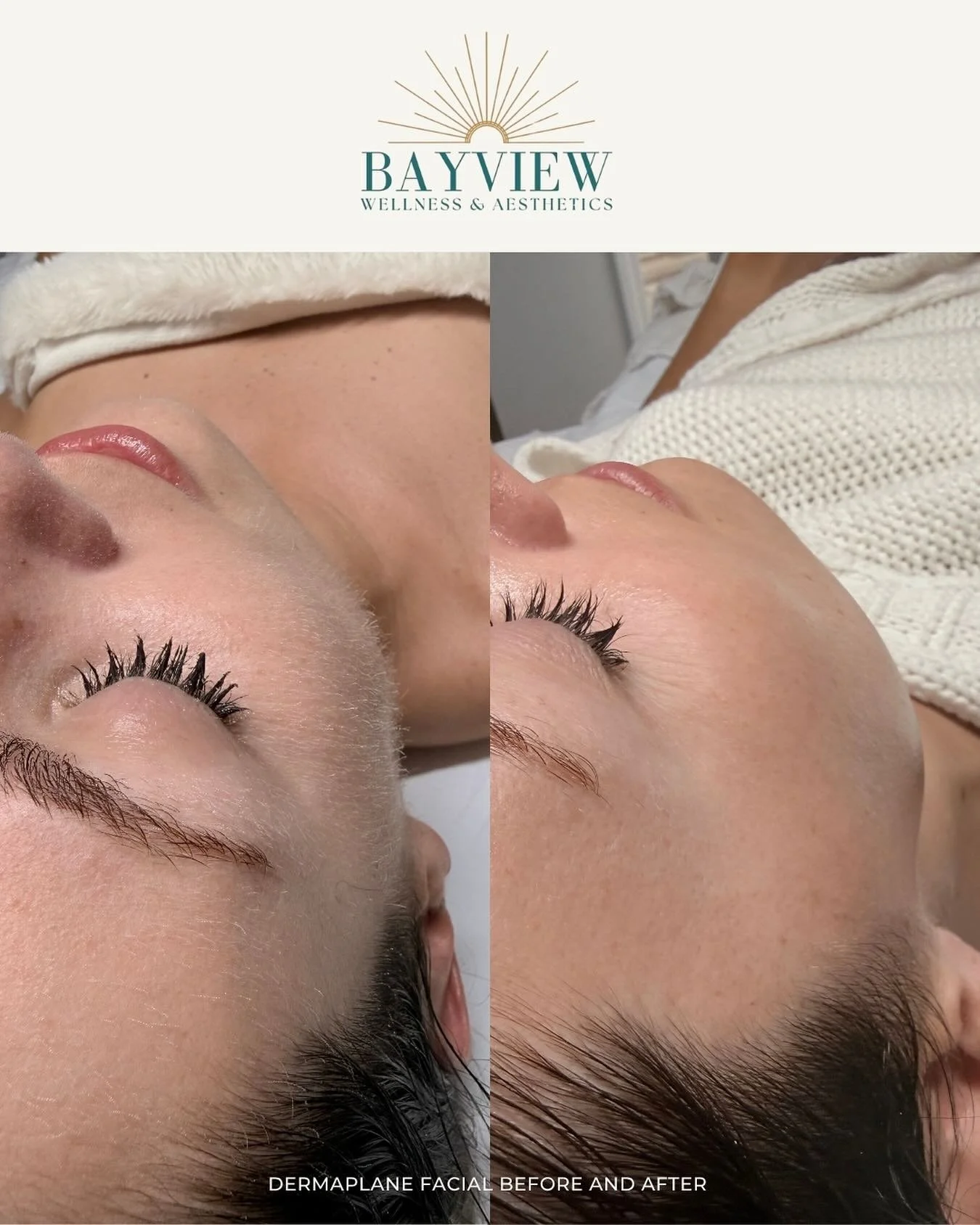 Don&rsquo;t skip the first steps into healthy, beautiful skin! 
Luxury Skincare starts with a smooth canvas. Dermaplane facials maximize your products&rsquo; results and perfect your makeup application! 

DM, Link in bio or check our website to book!