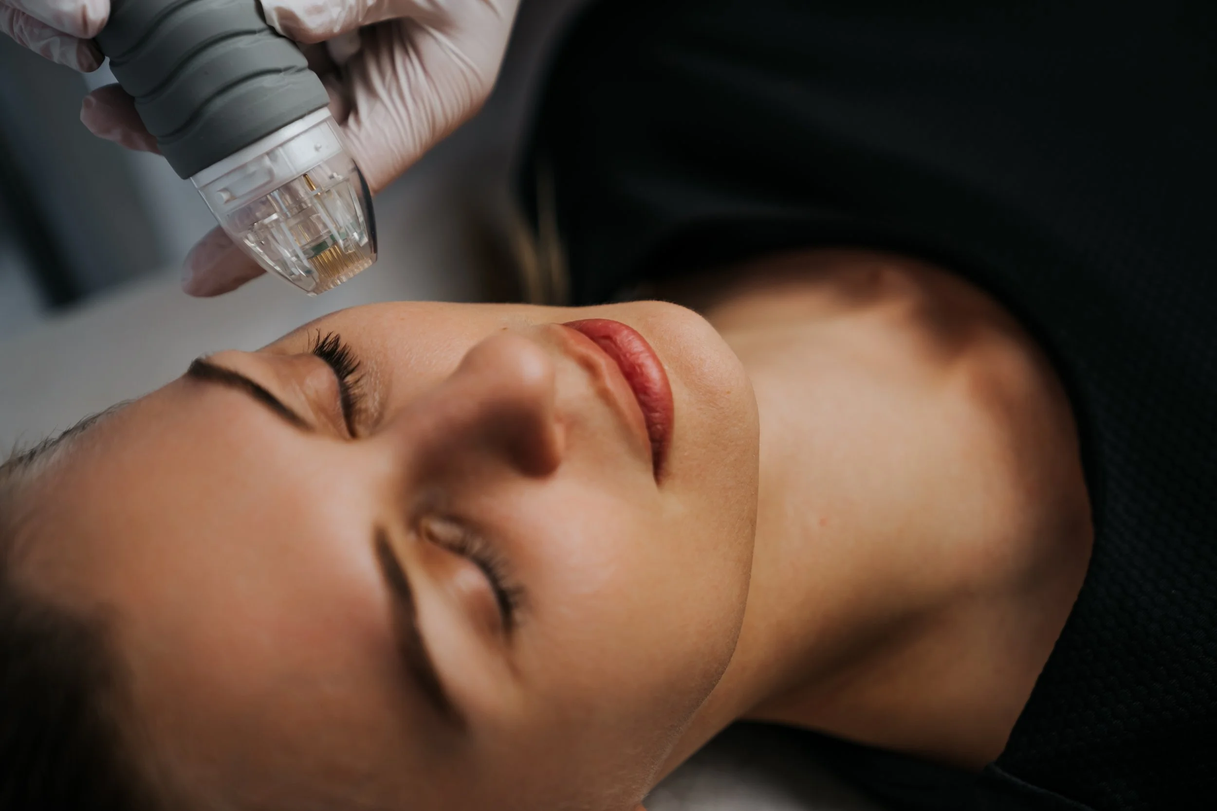 Radio Frequency Micro-Needling