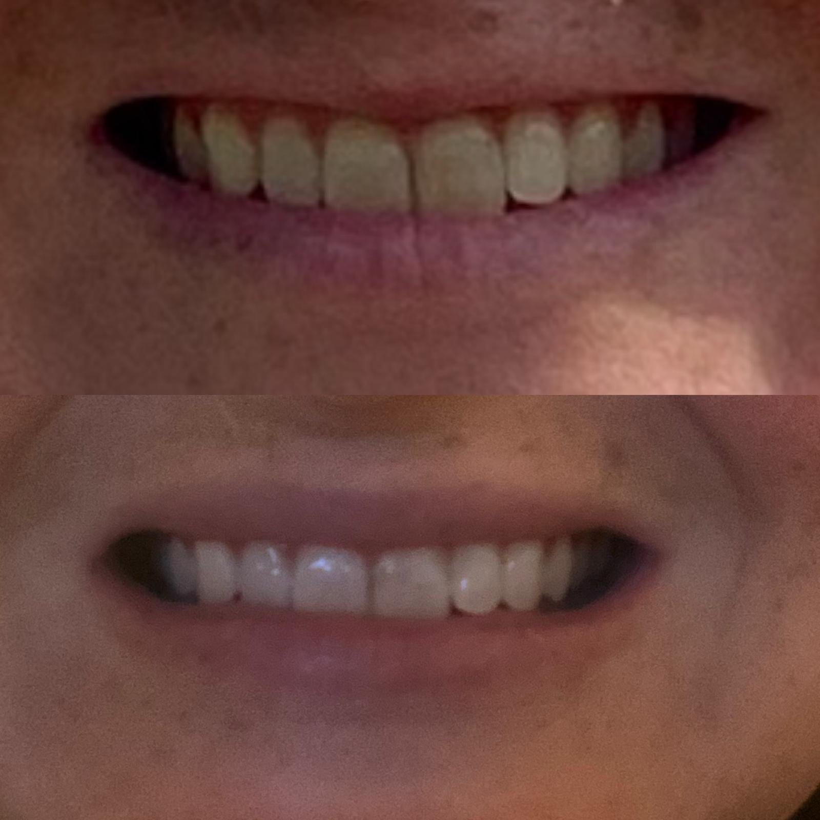 Lip flip to make upper lip fuller