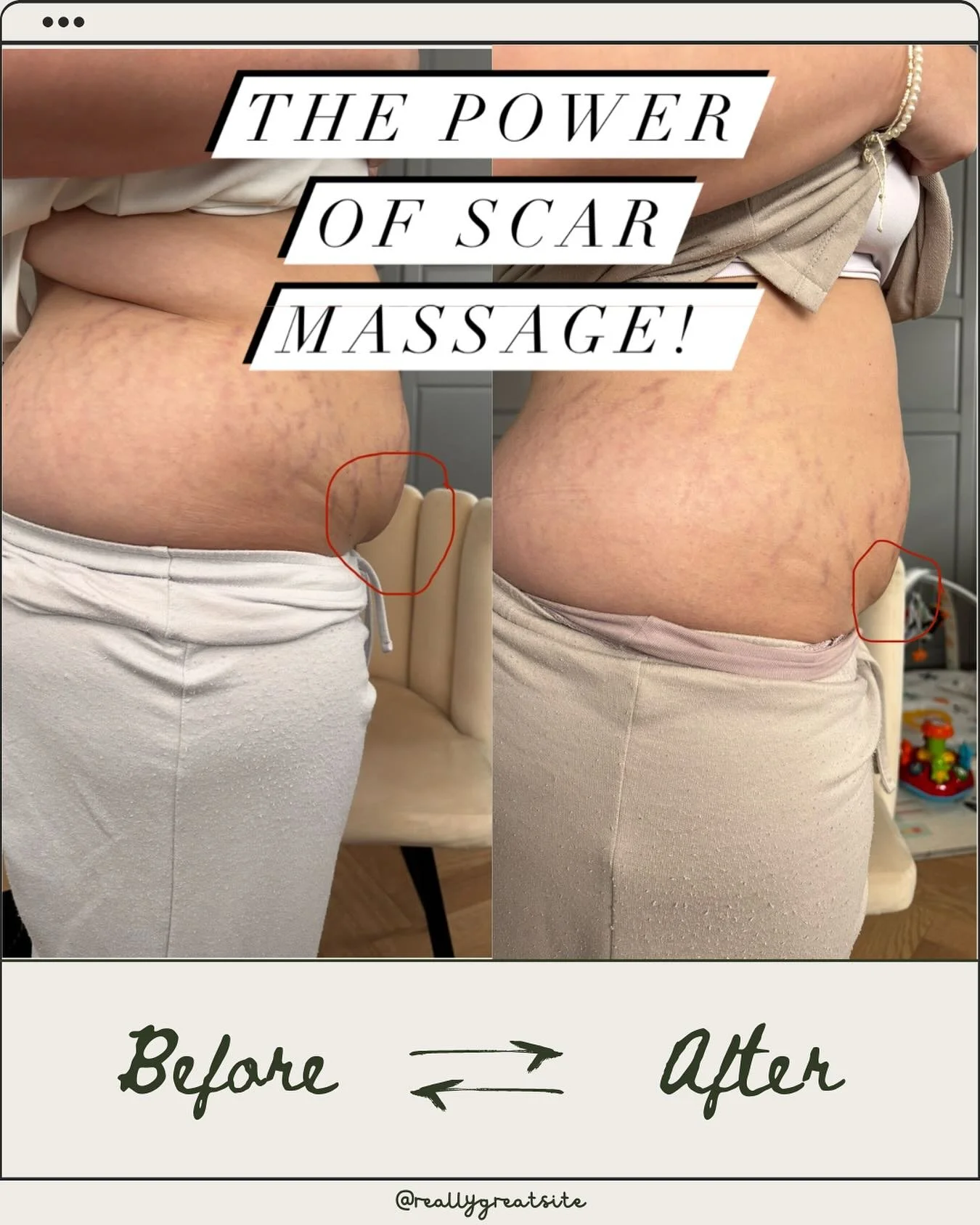 An absolutely lovely mamma who came back for some follow up massage and advise! 

⚠️Again the pictures speak for themselves! The shelf has absolutely reduced! 
The power of consistency! 
8 weeks of scar massage routine! 

🔤You can make real differen