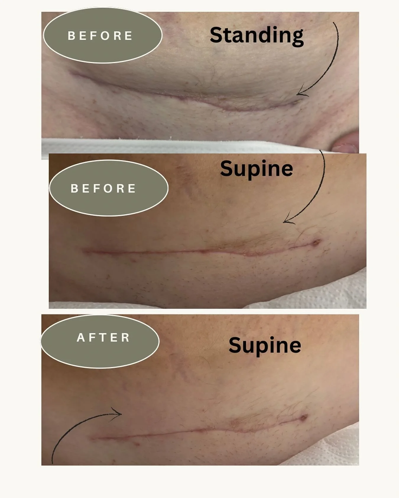 ✨ Another beautiful transformation from just ONE scar massage treatment! ✨

I love showing you the real results because every scar is so unique 💕

Did you know your scar can look completely different when you&rsquo;re standing vs. lying down? Many C